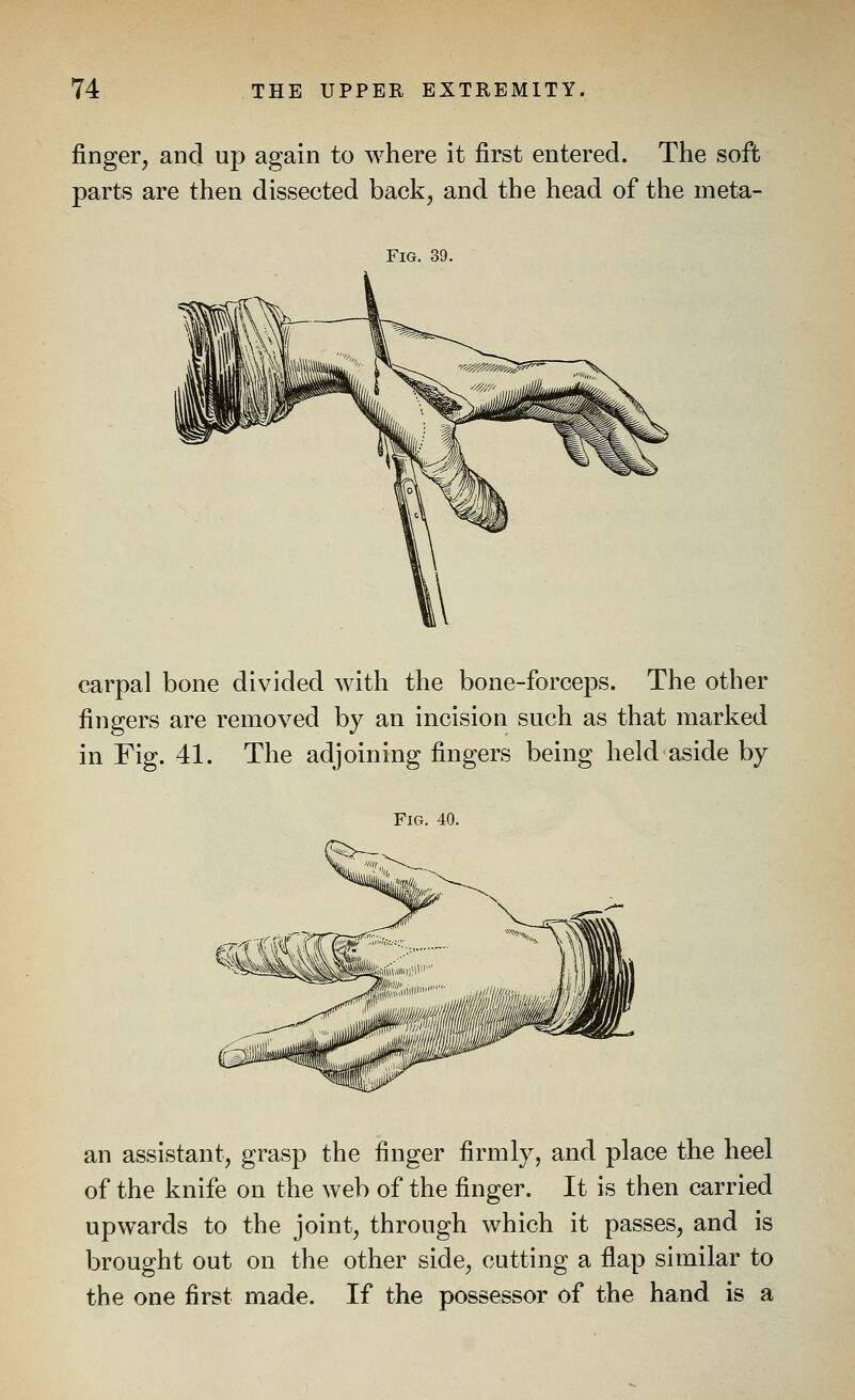 finger, and up again to where it first entered. The soft parts are then dissected back, and the head of the meta- carpal bone divided with the bone-forceps. The other fingers are removed by an incision such as that marked in Fig. 41. The adjoining fingers being held aside by Fig. 40. an assistant, grasp the finger firmly, and place the heel of the knife on the web of the finger. It is then carried upwards to the joint, through which it passes, and is brought out on the other side, cutting a flap similar to the one first made. If the possessor of the hand is a