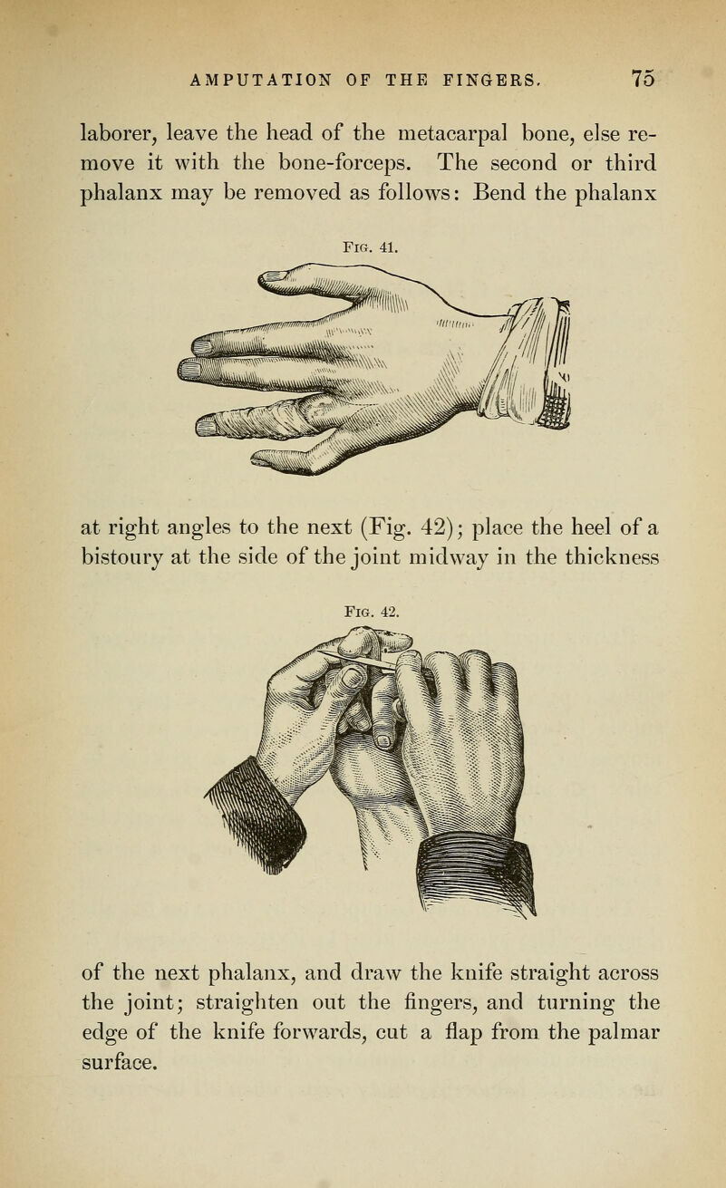 laborer, leave the head of the metacarpal bone, else re- move it with the bone-forceps. The second or third phalanx may be removed as follows: Bend the phalanx FiCx. 41. at right angles to the next (Fig. 42); place the heel of a bistoury at the side of the joint midway in the thickness Fig. 42. of the next phalanx, and draw the knife straight across the joint; straighten out the fingers, and turning the edge of the knife forw^ards, cut a flap from the palmar surface.