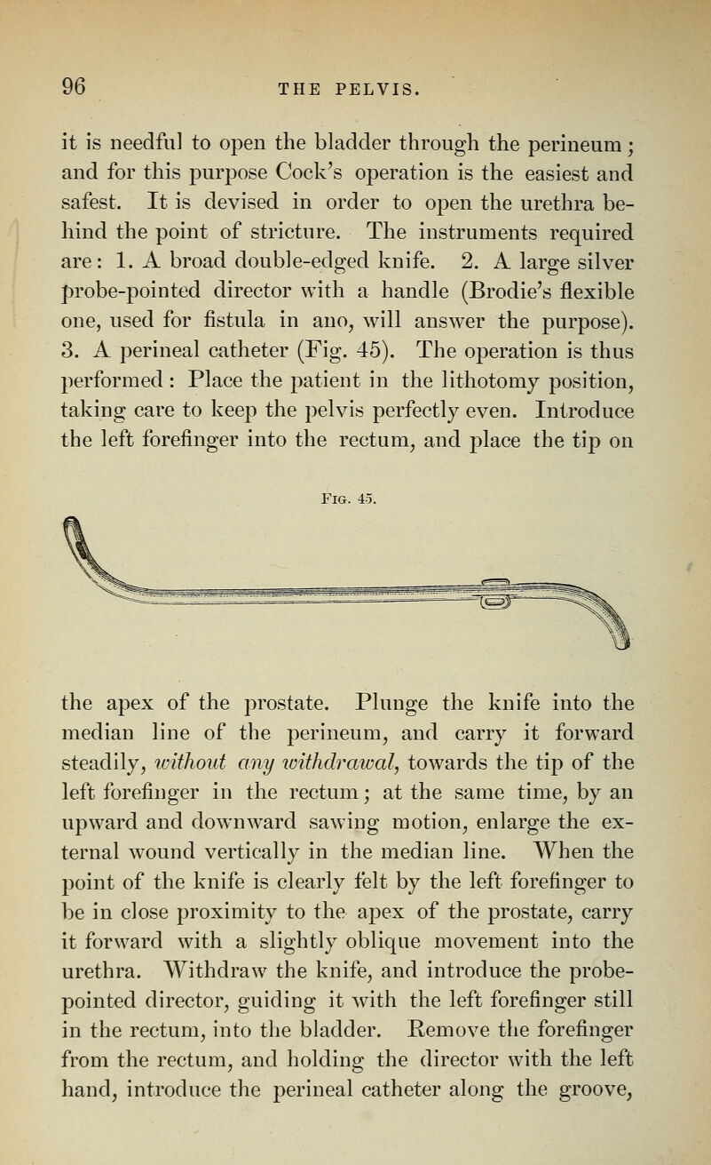 it is needful to open the bladder through the perineum; and for this j)nrpose Cock's operation is the easiest and safest. It is devised in order to open the urethra be- hind the point of stricture. The instruments required are: 1. A broad double-edged knife. 2. A large silver probe-pointed director with a handle (Brodie's flexible one, used for fistula in ano, will answer the purpose). 3. A perineal catheter (Fig. 45). The operation is thus performed: Place the patient in the lithotomy position, taking care to keep the pelvis perfectly even. Introduce the left forefinger into the rectum, and place the tip on Fig. 45. -^ the apex of the prostate. Plunge the knife into the median line of the perineum, and carry it forward steadily, tvithout any loithdrawal, towards the tip of the left forefinger in the rectum; at the same time, by an upward and downward sawing motion, enlarge the ex- ternal wound vertically in the median line. When the point of the knife is clearly felt by the left forefinger to be in close proximity to the apex of the prostate, carry it forward with a slightly oblique movement into the urethra. Withdraw the knife, and introduce the probe- pointed director, guiding it with the left forefinger still in the rectum, into the bladder. Remove the forefinger from the rectum, and holding the director with the left hand, introduce the perineal catheter along the groove,