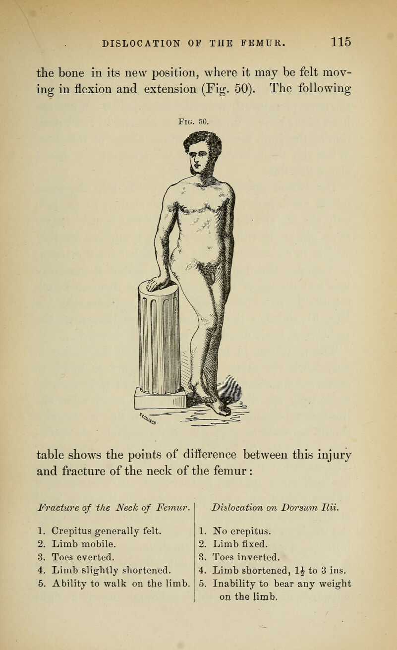 the bone in its new position, where it may be felt mov- ing in flexion and extension (Fig. 50). The following Fig. 50. table shows the points of difference between this injury and fracture of the neck of the femur: Fracture of the Neck of Feynur. 1. Crepitus generally felt. 2. Limb mobile. 3. Toes everted. 4. Limb slightly shortened. 5. Ability to walk on the limb. Dislocation on Dorsum Ilii. 1. No crepitus. 2. Limb fixed. 3. Toes inverted. 4. Limb shortened, IJ to 3 ins. 5. Inability to bear any weight on the Jimb,