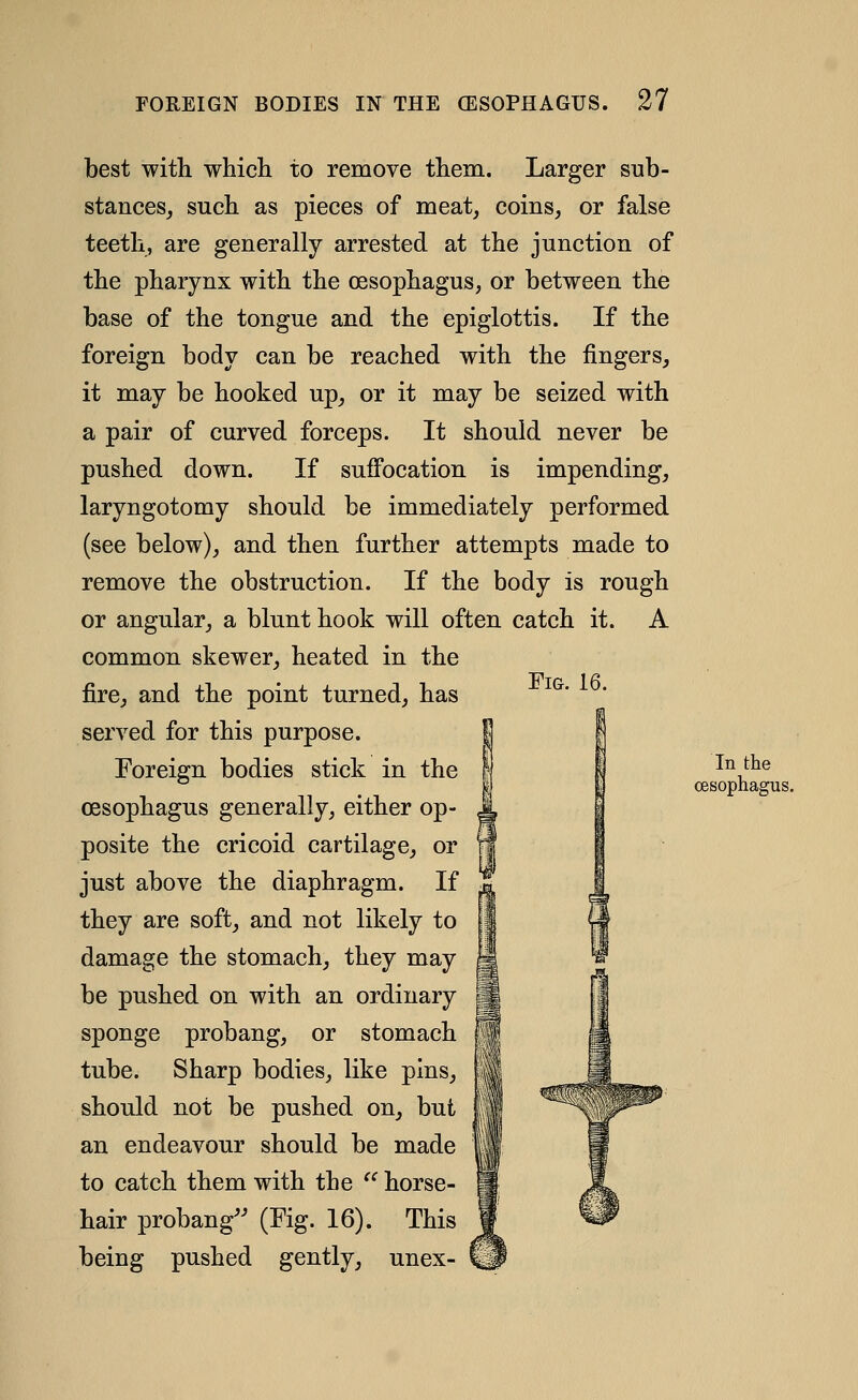 Fig. 16. best with whicli to remove them. Larger sub- stances, such as pieces of meat, coins, or false teeth, are generally arrested at the junction of the pharynx with the oesophagus, or between the base of the tongue and the epiglottis. If the foreign body can be reached with the fingers, it may be hooked up, or it may be seized with a pair of curved forceps. It should never be pushed down. If suffocation is impending, laryngotomy should be immediately performed (see below), and then further attempts made to remove the obstruction. If the body is rough or angular, a blunt hook will often catch it. A common skewer, heated in the fire, and the point turned, has served for this purpose. Foreign bodies stick in the oesophagus generally, either op- posite the cricoid cartilage, or just above the diaphragm. If they are soft, and not likely to damage the stomach, they may be pushed on with an ordinary sponge probang, or stomach tube. Sharp bodies, like pins, should not be pushed on, but an endeavour should be made to catch them with the '' horse- hair probang^' (Fig. 16). This being pushed gently, unex- In the oesophagus.