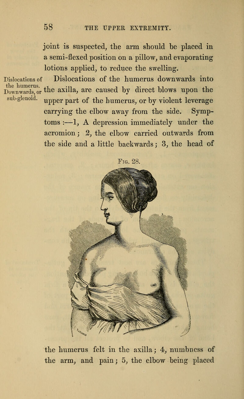 joint is suspected, the arm should be placed in a semi-flexed position on a pillow, and evaporating lotions applied_, to reduce the swelling. Dislocations of Dislocations of the humerus downwards into Dow nwards, or ^he axiUa, are caused by direct blows upon the sub-glenoid. ^ppgj. p^^t of the humerus, or by violent leverage carrying the elbow away from the side. Symp- toms :—1, A depression immediately under the acromion; 2, the elbow carried outwards from the side and a little backwards; 3, the head of Fig. 28. the humerus felt in the axilla; 4^ numbness of the arm, and pain; 5, the elbow being placed