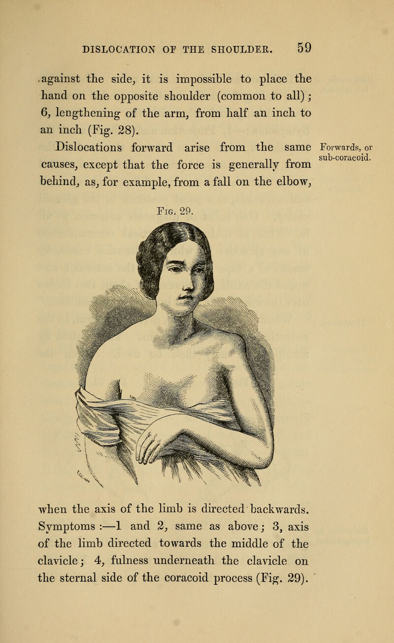 .against the side^ it is impossible to place the hand on the opposite shoulder (common to all) ; 6_, lengthening of the arm, from half an inch to an inch (Fig. 28). Dislocations forward arise from the same causes, except that the force is generally from behind, aSj for example, from a fall on the elbow. Forwards, or sub-coracoid. Fig. 29. when the axis of the limb is directed backwards. Symptoms :—1 and 2, same as above; 3, axis of the limb directed towards the middle of the clavicle; 4, fulness underneath the clavicle on the sternal side of the coracoid process (Fig. 29).