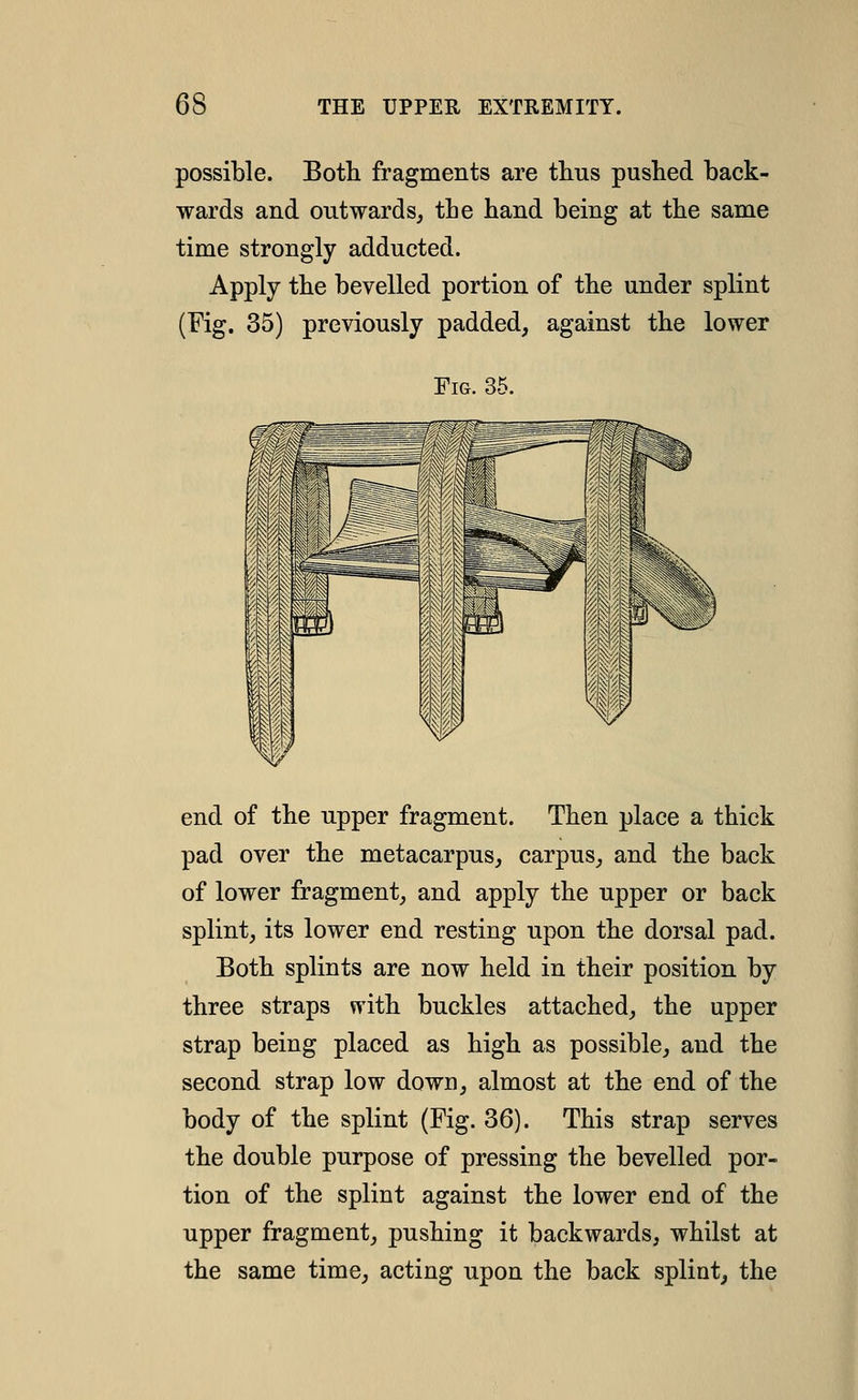 possible. Both fragments are tlius pushed back- wards and outwards^ the hand being at the same time strongly adducted. Apply the bevelled portion of the under splint (Eig. 35) previously padded, against the lower Fig. 35. end of the upper fragment. Then place a thick pad over the metacarpus, carpus, and the back of lower fragment, and apply the upper or back splint, its lower end resting upon the dorsal pad. Both splints are now held in their position by three straps with buckles attached, the upper strap being placed as high as possible, and the second strap low down, almost at the end of the body of the splint (Fig. 36). This strap serves the double purpose of pressing the bevelled por- tion of the splint against the lower end of the upper fragment, pushing it backwards, whilst at the same time, acting upon the back splint, the
