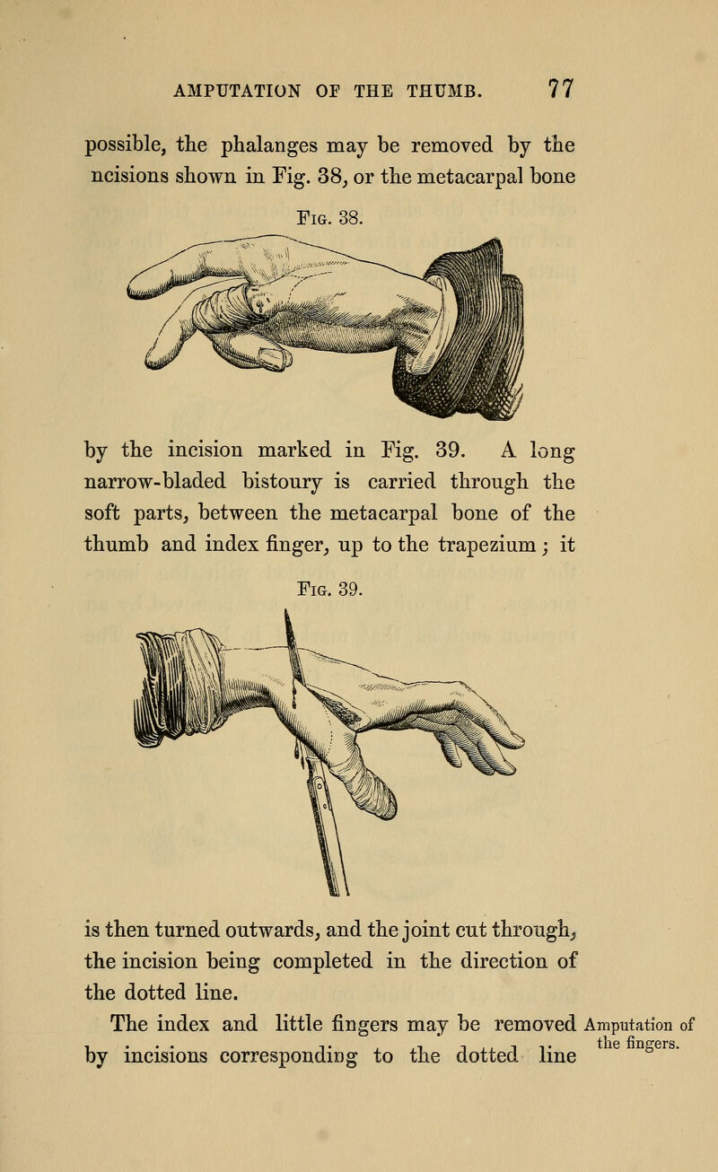 possible, the phalanges may be removed by the ncisions shown in Fig. 38, or the metacarpal bone Fig. 38. by the incision marked in Fig. 39. A long narrow-bladed bistoury is carried through the soft parts, between the metacarpal bone of the thumb and index finger, up to the trapezium; it Fig. 39. is then turned outwards, and the joint cut through^ the incision being completed in the direction of the dotted line. The index and little fingers may be removed Amputation of by incisions corresponding to the dotted line ^^ °^^^^'