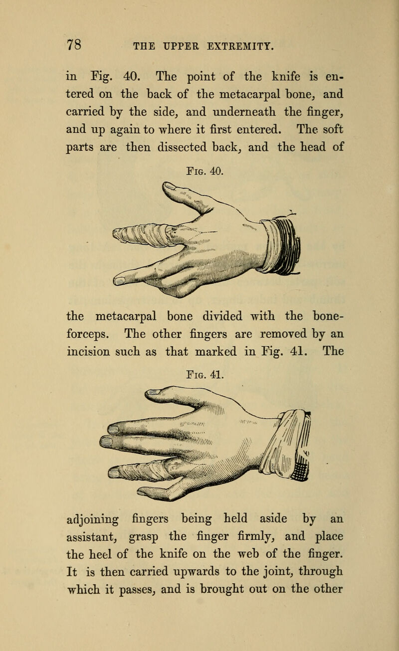 in Eig. 40. The point of the knife is en- tered on the back of the metacarpal bone^ and carried by the side,, and underneath the finger, and up again to where it first entered. The soft parts are then dissected back, and the head of Fig. 40. the metacarpal bone divided with the bone- forceps. The other fingers are removed by an incision such as that marked in Fig. 41. The Fig. 41. adjoining fingers being held aside by an assistant, grasp the finger firmly, and place the heel of the knife on the web of the finger. It is then carried upwards to the joint, through which it passes, and is brought out on the other