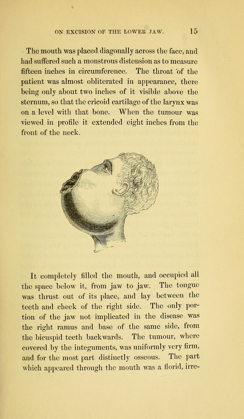 The mouth was placed diagonally across the face, and had suffered such a monstrous distension as to measure fifteen inches in circumference. The throat of the patient was almost obliterated in appearance, there being only about two inches of it visible above the sternum, so that the cricoid cartilage of the larynx was on a level with that bone. When the tumour was viewed in profile it extended eight inches from the front of the neck. It completely filled the mouth, and occupied all the space below it, from jaw to jaw. The tongue was thrust out of its place, and lay between the teeth and cheek of the right side. The only por- tion of the jaw not implicated in the disease was the right ramus and base of the same side, from the bicuspid teeth backwards. The tumour, where covered by the integuments, was uniformly very firm, and for the most part distinctly osseous. The part which appeared through the mouth was a florid, irre-