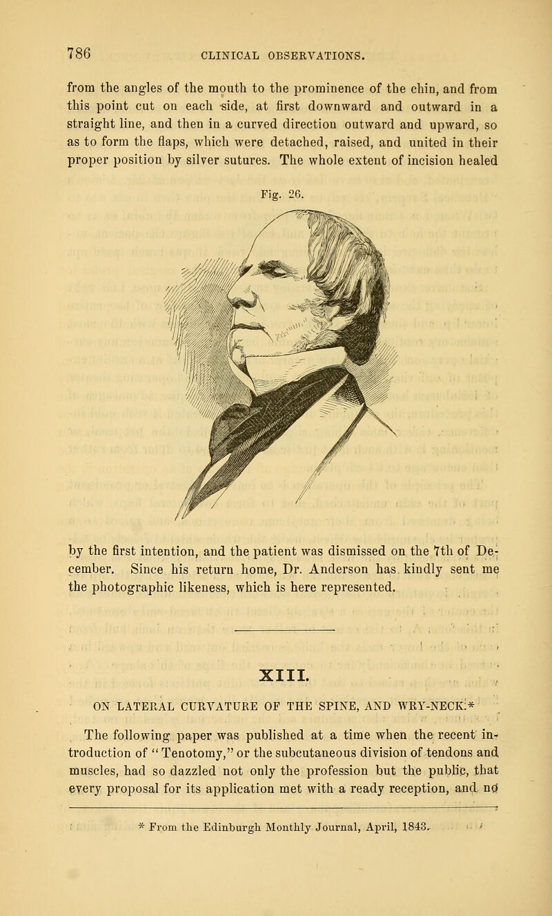 from the angles of the mouth to the prominence of the chin, and from this point cut on each side, at first downward and outward in a straight line, and then in a curved direction outward and upward, so as to form the flaps, which were detached, raised, and united in their proper position by silver sutures. The whole extent of incision healed Fig. 26. by the first intention, and the patient was dismissed on the ?th of De- cember. Since his return home, Dr. Anderson has. kindly sent me the photographic likeness, which is here represented. XIII. ON LATERAL CURVATURE OF THE SPINE, AND WRY-NECK:* The following paper was published at a time when the recent in- troduction of  Tenotomy, or the subcutaneous division of tendons and muscles, had so dazzled not only the profession but the public, that every proposal for its application met with a ready reception, and. no; * From the Edinburgh Monthly Journal, April, 1843.