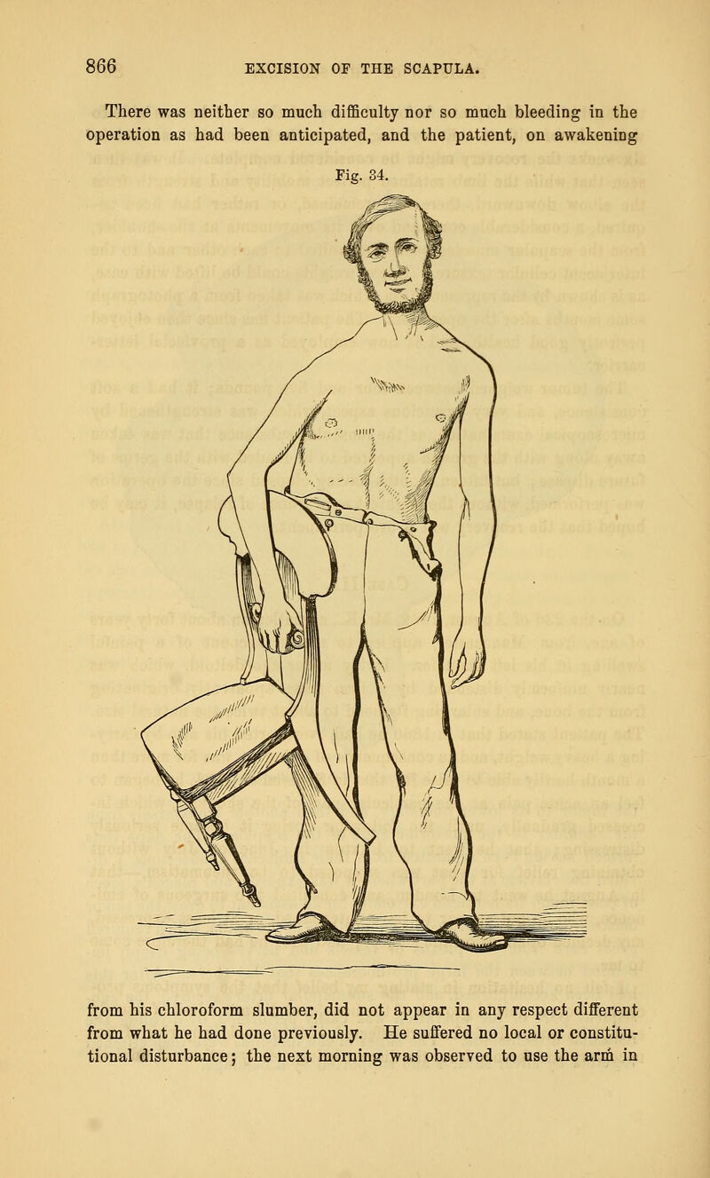 There was neither so much difficulty nor so much bleeding in the operation as had been anticipated, and the patient, on awakening Fig. 34. from his chloroform slumber, did not appear in any respect different from what he had done previously. He suffered no local or constitu- tional disturbance; the next morning was observed to use the arm in