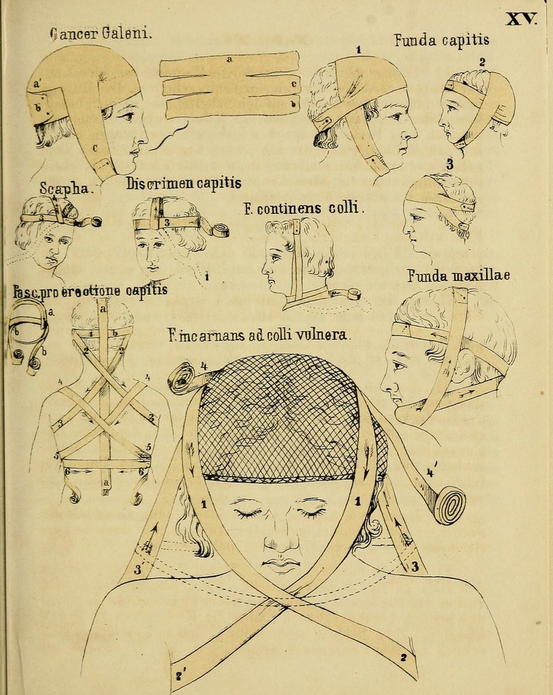 Cancer Galeni. xv: Punda capitis fesc.prDer8otioiie oamtis ?imda maxillae