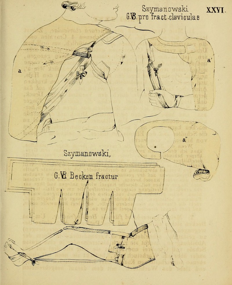 Szymaiiowsld XXYL G.B.Tiro fract-claviculae