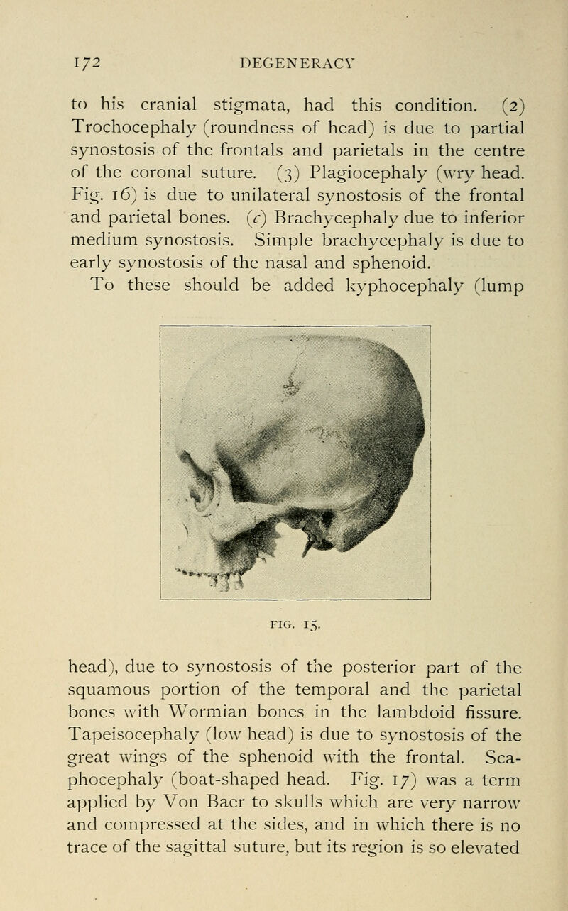 to his cranial stigmata, had this condition. (2) Trochocephaly (roundness of head) is due to partial synostosis of the frontals and parietals in the centre of the coronal suture. (3) Plagiocephaly (wry head. Fig. 16) is due to unilateral synostosis of the frontal and parietal bones, (f) Brachycephaly due to inferior medium synostosis. Simple brachycephaly is due to early synostosis of the nasal and sphenoid. To these should be added kyphocephaly (lump FIG. 15. head), due to synostosis of the posterior part of the squamous portion of the temporal and the parietal bones with Wormian bones in the lambdoid fissure. Tapeisocephaly (low head) is due to synostosis of the great wings of the sphenoid with the frontal. Sca- phocephaly (boat-shaped head. Fig. 17) was a term applied by Von Baer to skulls which are very narrow and compressed at the sides, and in which there is no trace of the sagittal suture, but its region is so elevated