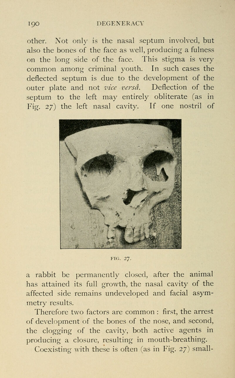 T90 other. Not only is the nasal septum involved, but also the bones of the face as well, producing a fulness on the long side of the face. This stigma is very common among criminal youth. In such cases the deflected septum is due to the development of the outer plate and not vice versa. Deflection of the septum to the left may entirely obliterate (as in Fig. 27) the left nasal cavity. If one nostril of FIG. 27. a rabbit be permanently closed, after the animal has attained its full growth, the nasal cavity of the affected side remains undeveloped and facial asym- metry results. Therefore two factors are common : first, the arrest of development of the bones of the nose, and second, the clogging of the cavity, both active agents in producing a closure, resulting in mouth-breathing. Coexisting with these is often (as in Fig. 27) small-