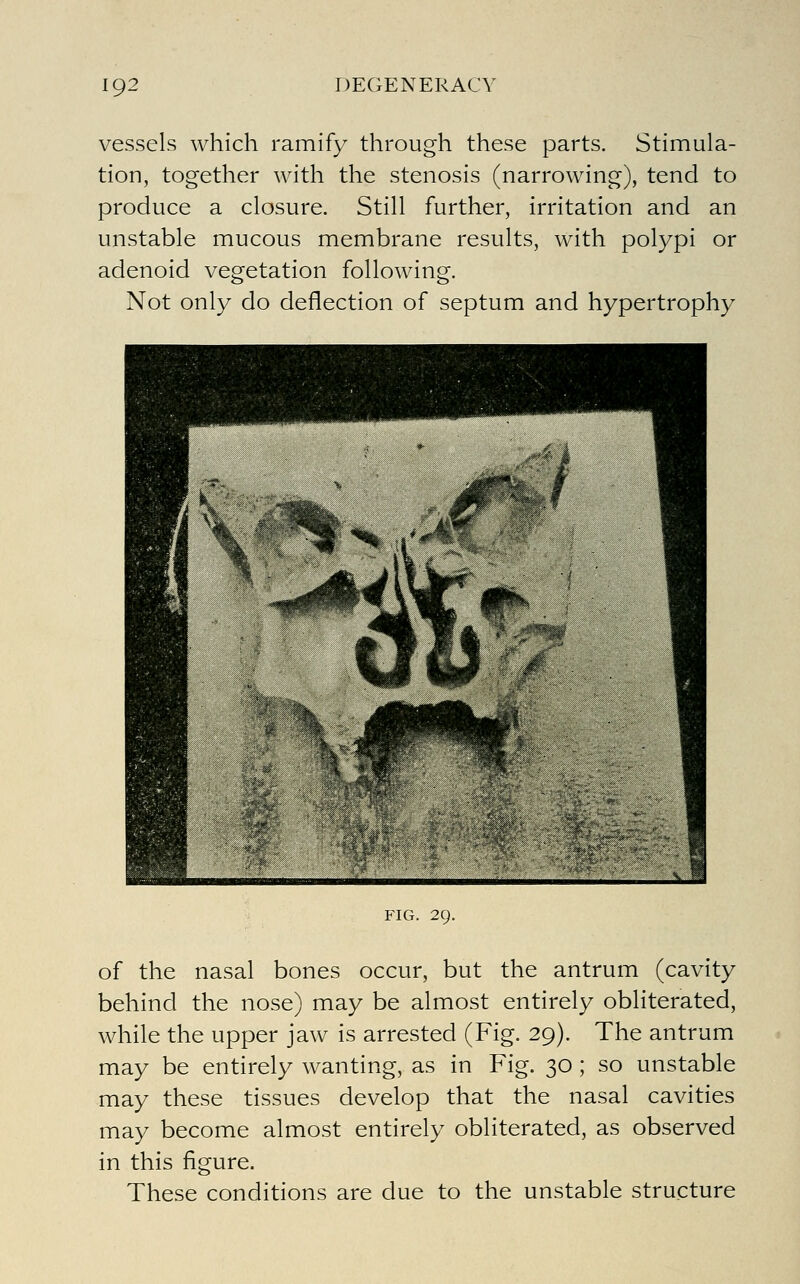 vessels which ramify through these parts. Stimula- tion, together with the stenosis (narrowing), tend to produce a closure. Still further, irritation and an unstable mucous membrane results, with polypi or adenoid vegetation following. Not only do deflection of septum and hypertrophy FIG. 29. of the nasal bones occur, but the antrum (cavity behind the nose) may be almost entirely obliterated, while the upper jaw is arrested (Fig. 29). The antrum may be entirely wanting, as in Fig. 30 ; so unstable may these tissues develop that the nasal cavities may become almost entirely obliterated, as observed in this figure. These conditions are due to the unstable structure