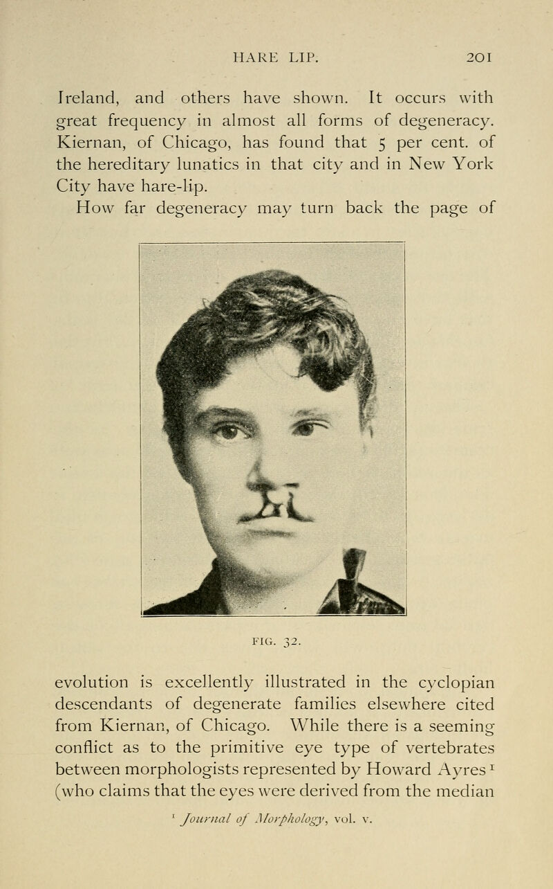 Ireland, and others have shown. It occurs with great frequency in almost all forms of degeneracy. Kiernan, of Chicago, has found that 5 per cent, of the hereditary lunatics in that city and in New York City have hare-lip. How far degeneracy may turn back the page of FIG. 32. evolution is excellently illustrated in the cyclopian descendants of degenerate families elsewhere cited from Kiernan, of Chicago. While there is a seeming conflict as to the primitive eye type of vertebrates between morphologists represented by Howard Ayres ^ (who claims that the eyes were derived from the median ' Journal of ^fol■pholog^y, vol. \'.