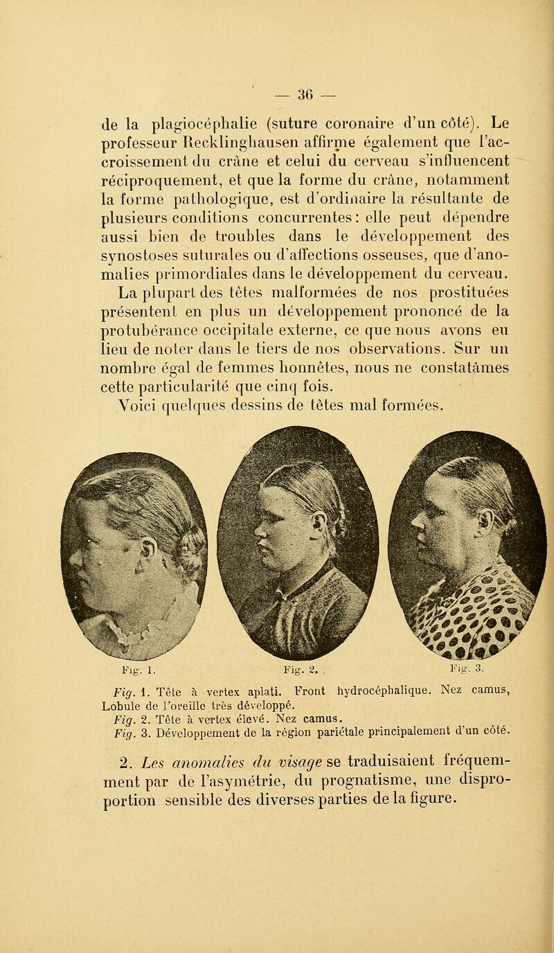 — 30 — de la plagiocéphalie (suture coronaire d'un côté). Le professeur Recklinghausen affirme également que l'ac- croissement du crâne et celui du cerveau s'influencent réciproquement, et que la forme du crâne, notamment la forme pathologique, est d'ordinaire la résultante de plusieurs conditions concurrentes : elle peut dépendre aussi bien de troubles dans le développement des synostoses suturâtes ou d'affections osseuses, que d'ano- malies primordiales dans le développement du cerveau. La plupart des têtes malformées de nos prostituées présentent en plus un développement prononcé de la protubérance occipitale externe, ce que nous avons eu lieu de noter dans le tiers de nos observations. Sur un nombre égal de femmes honnêtes, nous ne constatâmes cette particularité que cinq fois. Voici quelques dessins de têtes mal formées. Fig. \. Tête ^ vertex aplati. Front hydrocéphalique. Nez camus, Lobule de roreille très développé. Fig. 2. Tète à vertex élevé. Nez camus. Fig. 3. Développement de la région pariétale principalement d'un côté. 2. Les ano7nalies du visage se traduisaient fréquem- ment par de l'asymétrie, du prognatisme, une dispro- portion sensible des diverses parties de la figure.