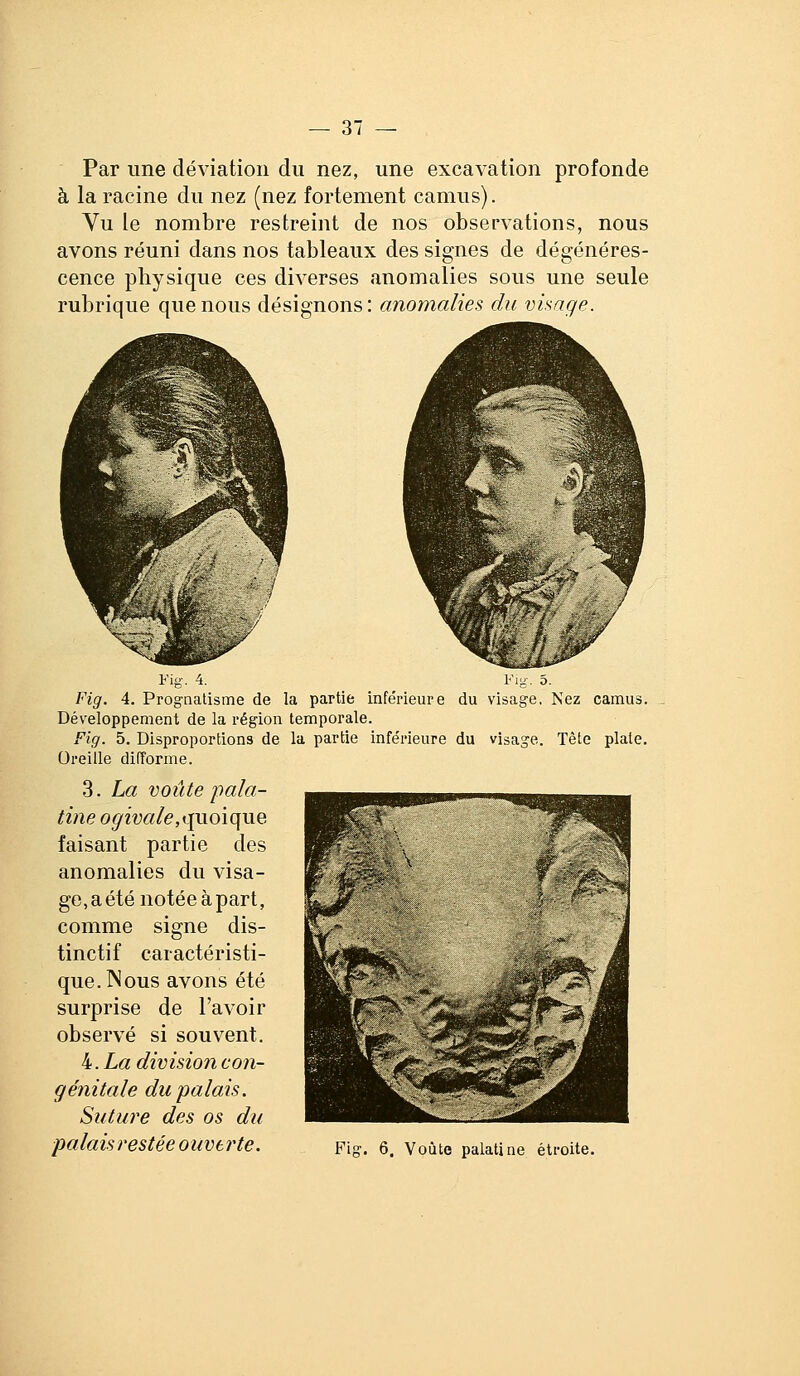 Par une déviation du nez, une excavation profonde à la racine du nez (nez fortement camus). Vu le nombre restreint de nos observations, nous avons réuni dans nos tableaux des signes de dégénéres- cence physique ces diverses anomalies sous une seule rubrique que nous désignons: anomalies du visage. Fig. 4. Fig. 5. Fig. 4. Prognatisme de la partie inférieure du visage, Nez camus. Développement de la région temporale. Fig. 5. Disproportions de la partie infe'rieure du visage. Tête plate. Oreille difforme. 3. La voûte pala- tine o^râ«/e,quoique faisant partie des anomalies du visa- ge, a été notée à part, comme signe dis- tinctif caractéristi- que. Nous avons été surprise de l'avoir observé si souvent. 4. Z,« division con- génitale du palais. Suture des os du palais restée ouverte. Fig. 6. Voùle palatine étroite.