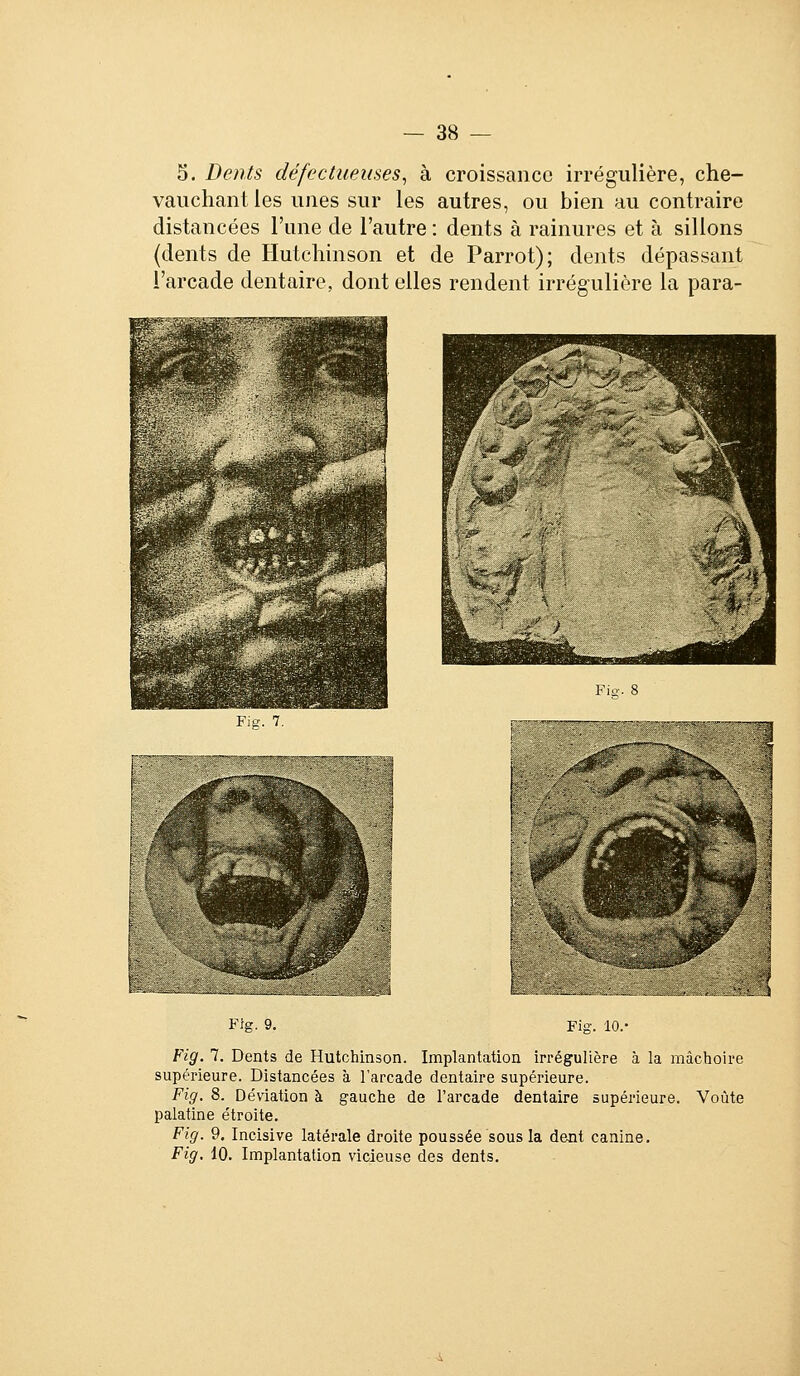 5. Dents défectueuses^ à croissance irrégulière, che- vauchant les unes sur les autres, ou bien au contraire distancées l'une de l'autre : dents à rainures et à sillons (dents de Hutchinson et de Parrot); dents dépassant l'arcade dentaire, dont elles rendent irrégulière la para- Fio-. 8 ¥iîi. 7. Fig. 9. Fig. lO.' Fig. 7. Dents de Hutchinson. Implantation irrégulière à la mâchoire supérieure. Distancées à l'arcade dentaire supérieure. Fig. 8. Déviation à gauche de l'arcade dentaire supérieure. Voûte palatine étroite. Fig. 9. Incisive latérale droite poussée sous la dent canine. Fig. 10. Implantation vicieuse des dents.