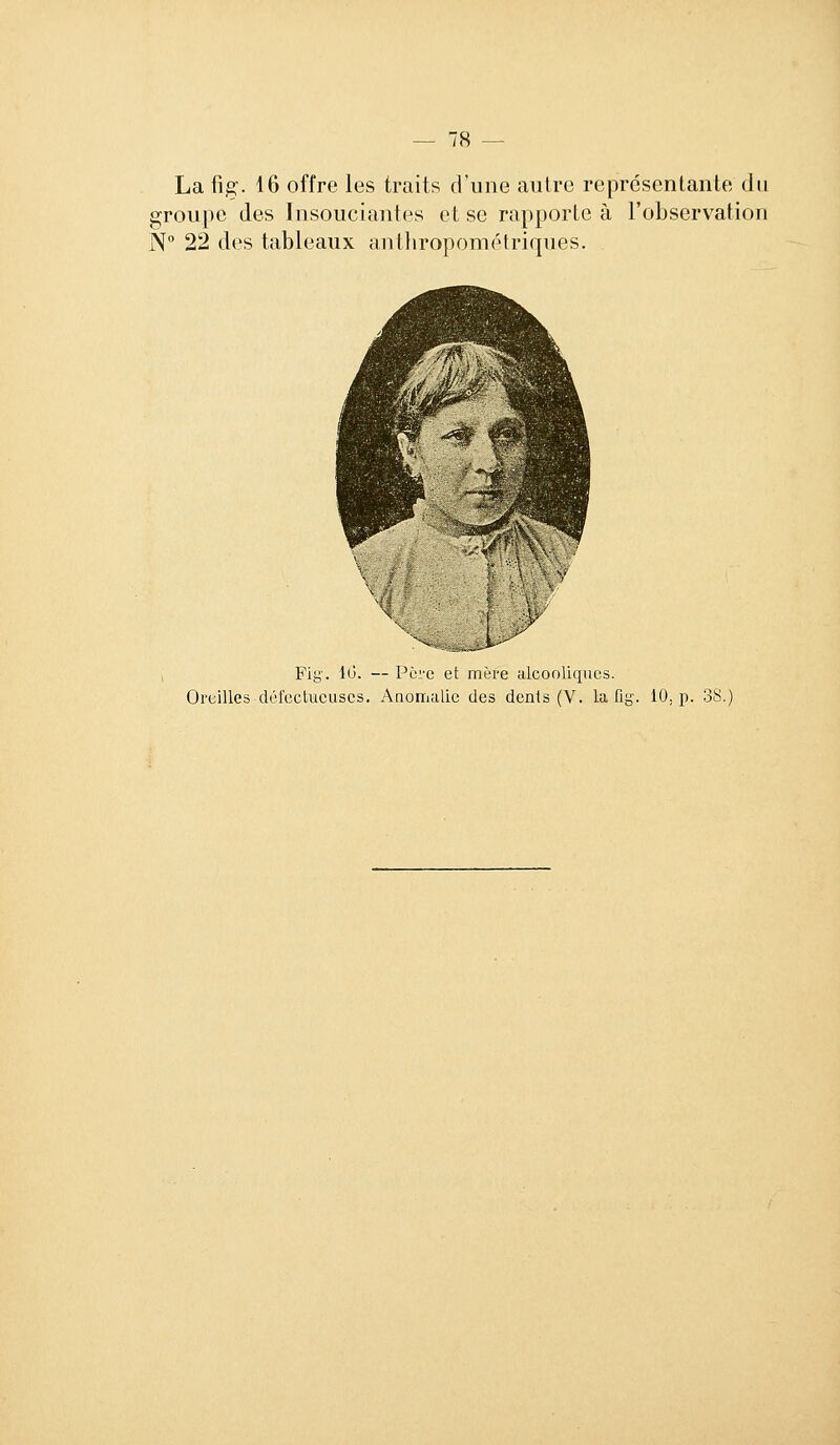 La fig'. 16 offre les traits d'une antre représentante du groupe des Insouciantes et se rapporte à l'observation N 22 des tableaux antliropométriqnes. Fig. 1(3. — Pèi'e et mère alcooliques. Oreilles défectueuses. Anomalie des dents (V. la fi g. 10, p. 38.)