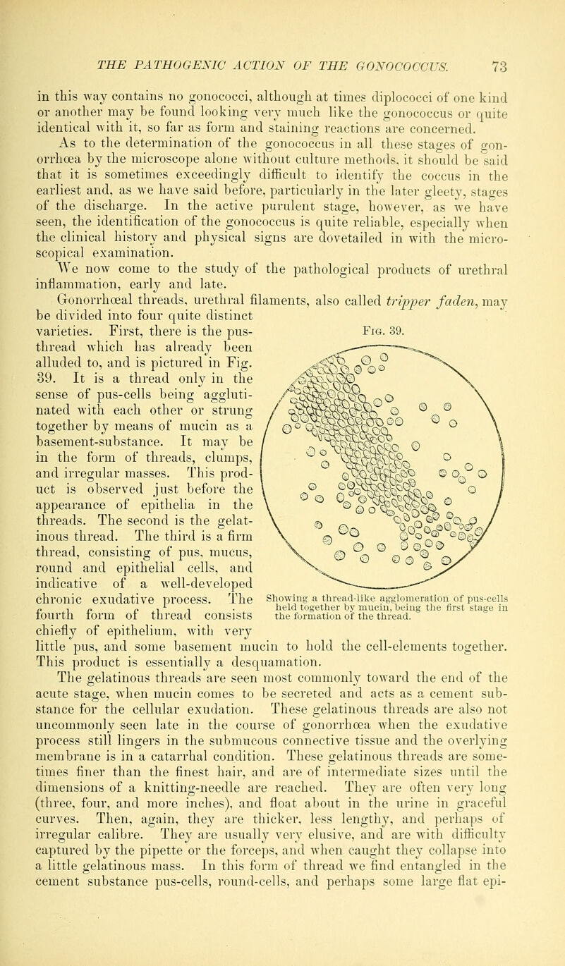 in this way contains no gonococci, although at times diplococci of one kind or another may be found looking very much like the gonococcus or quite identical with it, so far as form and staining reactions are concerned. As to the determination of the gonococcus in all these stages of gon- orrhoea by the microscope alone without culture methods, it should be said that it is sometimes exceedingly difficult to identify the coccus in the earliest and, as we have said before, particularly in the later gleety, stao-es of the discharge. In the active purulent stage, however, as we have seen, the identification of the gonococcus is quite reliable, especially Avhen the clinical history and physical signs are dovetailed in with the micro- scopical examination. We now come to the study of the pathological products of urethral inflammation, early and late. Gonorrhoeal threads, urethral filaments, also called tripper faden, may be divided into four quite distinct varieties. First, there is the pus- Fig. 39. thread which has already been alluded to, and is pictured in Fig. 39. It is a thread only in the sense of pus-cells being aggluti- nated with each other or strung together by means of mucin as a basement-substance. It may be in the form of threads, clumps, and irregular masses. This prod- uct is observed just before the appearance of epithelia in the threads. The second is the gelat- inous thread. The third is a firm thread, consisting of pus, mucus, round and epithelial cells, and indicative of a well-developed chronic exudative process. The fourth form of thread consists chiefly of epithelium, with very little pus, and some basement mucin to hold the cell-elements together. This product is essentially a desquamation. The gelatinous threads are seen most commonly toward the end of the acute stage, when mucin comes to be secreted and acts as a cement sub- stance for the cellular exudation. These gelatinous threads are also not uncommonly seen late in the course of gonorrhoea when the exudative process still lingers in the submucous connective tissue and the overlying membrane is in a catarrhal condition. These gelatinous threads are some- times finer than the finest hair, and are of intermediate sizes until the dimensions of a knitting-needle are reached. Ihey are often very long (three, four, and more inches), and float about in the urine in graceful curves. Then, again, they are thicker, less lengthy, and perhaps of irregular calibre. They are usually very elusive, and are with difliculty captured by the pipette or the forceps, and when caught they collapse into a little gelatinous mass. In this form of thread we find entangled in the cement substance pus-cells, round-cells, and perhaps some large flat epi- Showing a thread-like agglomeration of pus-cells held together by mucin, being the first stage in the formation of the thread.