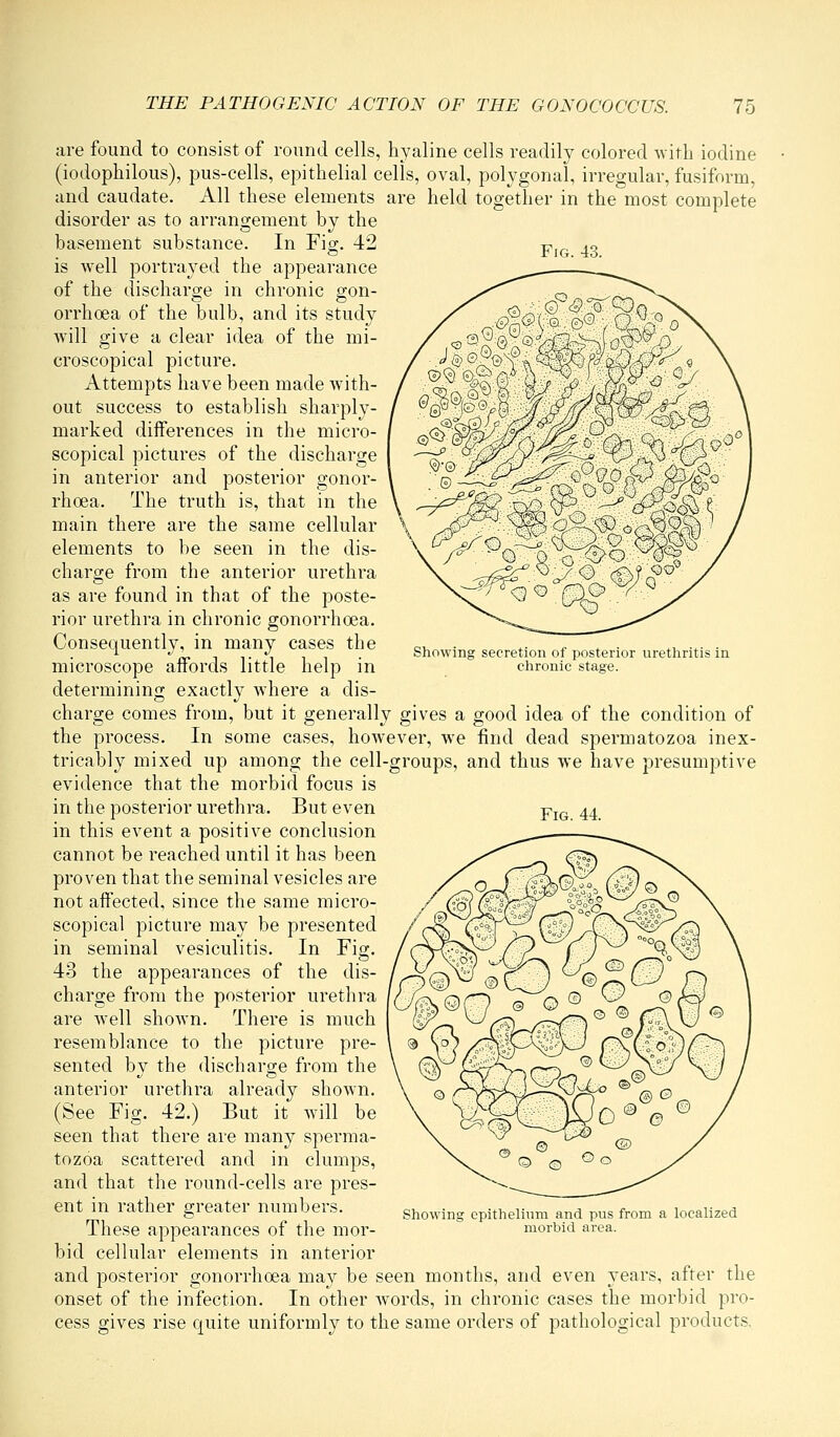 Fig. 43. Showing secretion of posterior urethritis in chronic stage. are found to consist of round cells, hyaline cells readily colored with iodine (iodophilous), pus-cells, epithelial cells, oval, polygonal, irregular, fusiform, and caudate. All these elements are held together in the most complete disorder as to arrangement by the basement substance. In Fig;. 42 is well portrayed the appearance of the discharge in chronic gon- orrhoea of the bulb, and its study will give a clear idea of the mi- croscopical picture. Attempts have been made with- out success to establish sharply- marked differences in the micro- scopical pictures of the discharge in anterior and posterior gonor- rhoea. The truth is, that in the main there are the same cellular elements to be seen in the dis- charge from the anterior urethra as are found in that of the poste- rior urethra in chronic gonorrhoea. Consequently, in many cases the microscope affords little help in determining exactly where a dis- charge comes from, but it generally gives a good idea of the condition of the process. In some cases, however, we find dead spermatozoa inex- tricably mixed up among the cell-groups, and thus we have presumptive evidence that the morbid focus is in the posterior urethra. But even in this event a positive conclusion cannot be reached until it has been proven that the seminal vesicles are not affected, since the same micro- scopical picture may be presented in seminal vesiculitis. In Fig. 43 the appearances of the dis- charge from the posterior urethra are well shown. There is much resemblance to the picture pre- sented by the discharge from the anterior urethra already shown. (See Fig. 42.) But it will be seen that there are many sperma- tozoa scattered and in clumps, and that the round-cells are pres- ent in rather greater numbers. These appearances of the mor- bid cellular elements in anterior and posterior gonorrhoea may be seen months, and even years, after the onset of the infection. In other words, in chronic cases the morbid pro- cess gives rise quite uniformly to the same orders of pathological products. Fig. 44. Showing epithelium and pus from a localized morbid area.