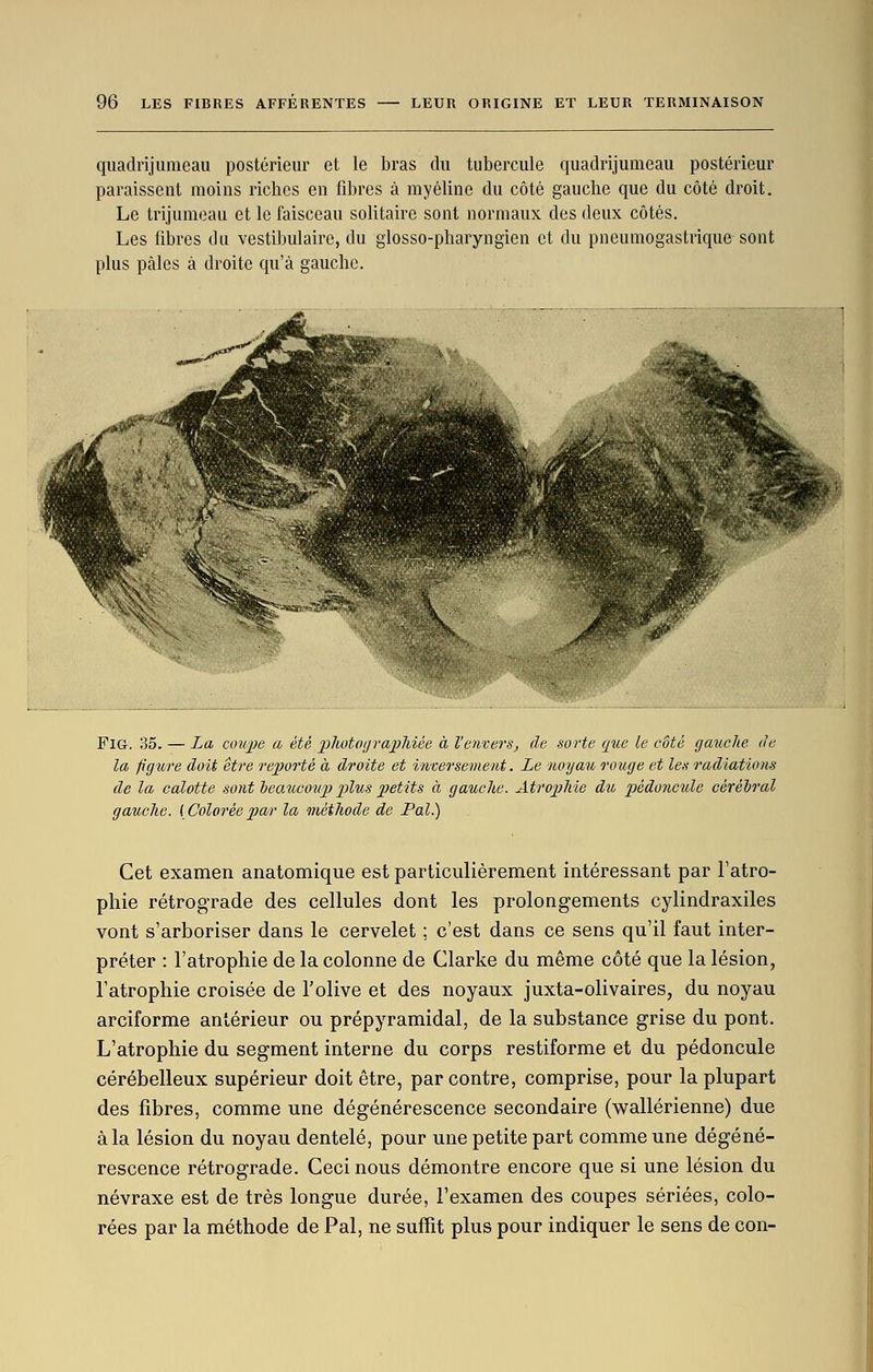 quadrijiimeau postérieur et le bras du tubercule quadrijumeau postérieur paraissent moins riches en fibres à myéline du côté gauche que du côté droit. Le trijumeau et le faisceau solitaire sont normaux des deux côtés. Les fibres du vestibulaire, du glosso-pharyngien et du pneumogastrique sont plus pâles à droite qu'à gauche. FiG. 35. — La cuu/pe a été photographiée à l'envers, de sorte que le côté gauche de la figure doit être reporté à droite et inversement. Le noyau rouge et les radiations de la calotte sont beaucoup plus petits à gauche. Atrophie dth pédoncule cérébral gauche. {Coloréepar la méthode de Pal.) Cet examen anatomique est particulièrement intéressant par l'atro- phie rétrograde des cellules dont les prolongements cylindraxiles vont s'arboriser dans le cervelet ; c'est dans ce sens qu'il faut inter- préter : l'atrophie de la colonne de Clarke du même côté que la lésion, l'atrophie croisée de l'olive et des noyaux juxta-olivaires, du noyau arciforme antérieur ou prépyramidal, de la substance grise du pont. L'atrophie du segment interne du corps restiforme et du pédoncule cérébelleux supérieur doit être, par contre, comprise, pour la plupart des fibres, comme une dégénérescence secondaire (wallérienne) due à la lésion du noyau dentelé, pour une petite part comme une dégéné- rescence rétrograde. Ceci nous démontre encore que si une lésion du névraxe est de très longue durée, l'examen des coupes sériées, colo- rées par la méthode de Pal, ne suffit plus pour indiquer le sens de con-