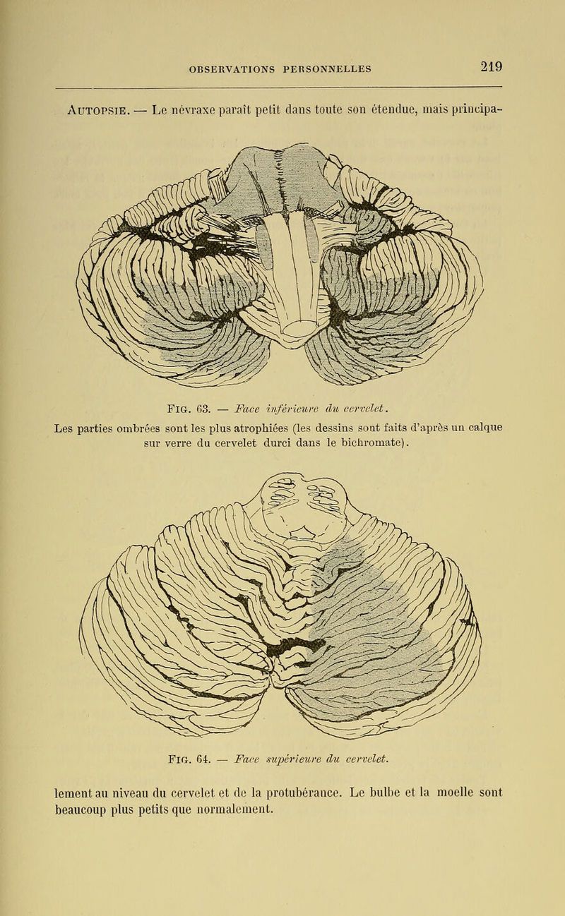 Autopsie. — Le névraxe paraît petit dans toute son étendue, mais principa- FlG. 63. — Face inférieure du cervelet. Les parties ombrées sont les plus atrophiées (les dessins sont faits d'après un calque sur verre du cervelet durci dans le bichromate). FiGr. 64. — Face nupérienre du cervelet. lement au niveau du cervelet et de la protubérance. Le bulbe et la moelle sont beaucoup plus petits que normalement.