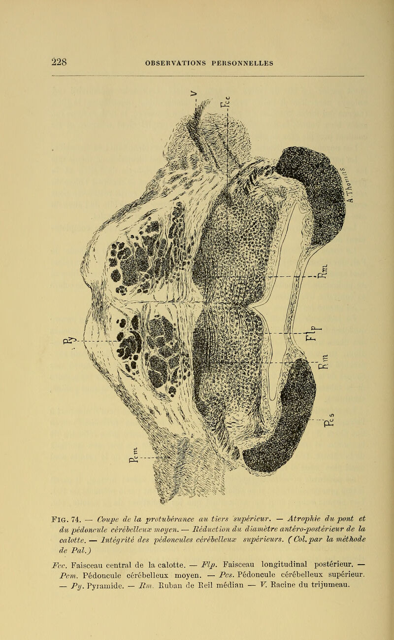 FiG. 74. — Coupe de la protubérance au tiers supérieur. — Atrophie du pont et du pédoncule céréhelleux moyen. — Héductlon du diamètre antéro-postérieur de la calotte. — Intégrité des ijédonciiles céréiellerix supérieurs. (Col,par la méthode de Pal.) Fec. Faisceau central de la calotte. — Flp. Faisceau longitudinal postérieur. — Pcm. Pédoncule cérébelleux moyen. — Pos. Pédoncule cérébelleux supérieur. — Py. Pyramide. — Iliti. Euban de Eeil médian — F. Eacine du trijumeau.