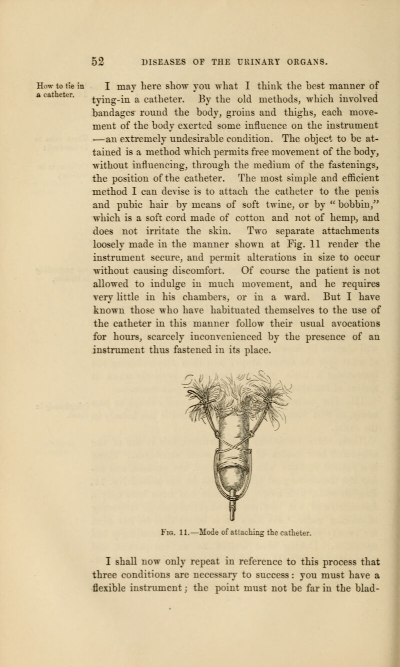 How to tie in a catheter. I may here show you what I think the best manner of tying-in a catheter. By the old methods, which involved bandages round the body, groins and thighs, each move- ment of the bodv exerted some influence on the instrument —an extremely undesirable condition. The object to be at- tained is a method which permits free movement of the body, without influencing, through the medium of the fastenings, the position of the catheter. The most simple and efficient method I can devise is to attach the catheter to the penis and pubic hair by means of soft twine, or by  bobbin/' which is a soft cord made of cotton and not of hemp, and does not irritate the skin. Two separate attachments loosely made in the manner shown at Fig. 11 render the instrument secure, and permit alterations in size to occur without causing discomfort. Of course the patient is not allowed to indulge in much movement, and he requires verv little in his chambers, or in a ward. But I have known those who have habituated themselves to the use of the catheter in this manner follow their usual avocations for hour's, scarcely inconvenienced by the presence of an instrument thus fastened in its place. ^ Fig. 11.—Mode of attaching the catheter. I shall now only repeat in reference to this process that three conditions are necessarv to success: vou must have a flexible instrument; the point must not be far in the blad-