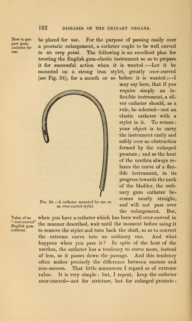 How to pre- be placed for use. For the purpose of passing easily over catheter for a prostatic enlargement, a catheter ought to be well curved use- to its very point. The following is an excellent plan for treating the English gum-elastic instrument so as to prepare it for successful action when it is wanted :—Let it be mounted on a strong iron stylet, greatly over-curved (see Fig. 34), for a month or so before it is wanted:—I may say here, that if you require simply an in- flexible instrument, a sil- ver catheter should, as a rule, be selected—not an elastic catheter with a stvlet in it. To return : your object is to carry the instrument easily and safely over an obstruction formed by the enlarged prostate ; and as the heat of the urethra always re- laxes the curve of a flex- ible instrument, in its progress towards the neck of the bladder, the ordi- nary gum catheter be- comes nearly straight, and will not pass over the enlargement. But, when you have a catheter which has been well over-curved in the manner described, wait until the moment before using it Fig. 34.—A catheter mounted for use on an over-curved stylet. Value of an  over-curve English gum- catheter. to remove the stylet and turn back the shaft, so as to convert the extreme curve into an ordinary one. And what happens when you pass it? In spite of the heat of the urethra, the catheter has a tendency to curve more, instead of less, as it passes down the passage. And this tendency often makes precisely the difference between success and non-success. That little manoeuvre I regard as of extreme value. It is very simple : but, I repeat, keep the catheter over-curved—not for stricture, but for enlarged prostate :