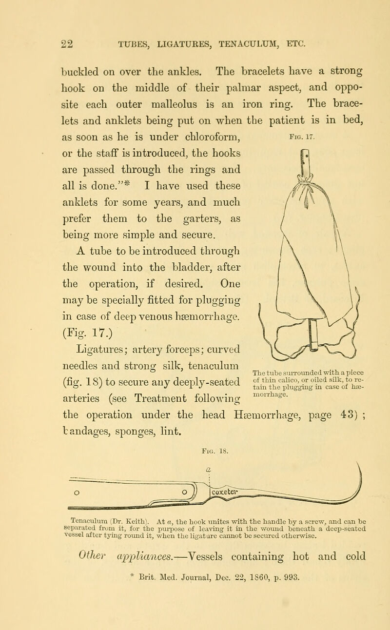 buckled on over the ankles. The bracelets have a strong hook on the middle of their palmar aspect, and oppo- site each outer malleolus is an iron ring. The brace- lets and anklets being put on when the patient is in bed, as soon as he is under chloroform, fig. it. or the staff is introduced, the hooks are passed through the rings and all is done.* I have used these anklets for some years, and much prefer them to the garters, as being more simple and secure. A tube to be introduced through the wound into the bladder, after the operation, if desired. One may be specially fitted for plugging in case of deep venous haemorrhage. (Fig- 17.) Ligatures; artery forceps; curved needles and strong silk, tenaculum (fig. 18) to secure any deeply-seated arteries (see Treatment following the operation under the head Haemorrhage, page 43 bandages, sponges, lint. The tube surrounded with a piece of thin calico, or oiled silk, to re- tain the plugging in case of hae- morrhage. Tenaculum (Dr. Keith). At a, the hook unites with the handle by a screw, and can be separated from it, for the purpose of leaving it in the wound beneath a deep-seated vessel after tying round it, when the ligature cannot be secured otherwise. Other appliances.—Vessels containing hot and cold Brit. Med. Journal, Dec. 22, 1S60, p. 993.