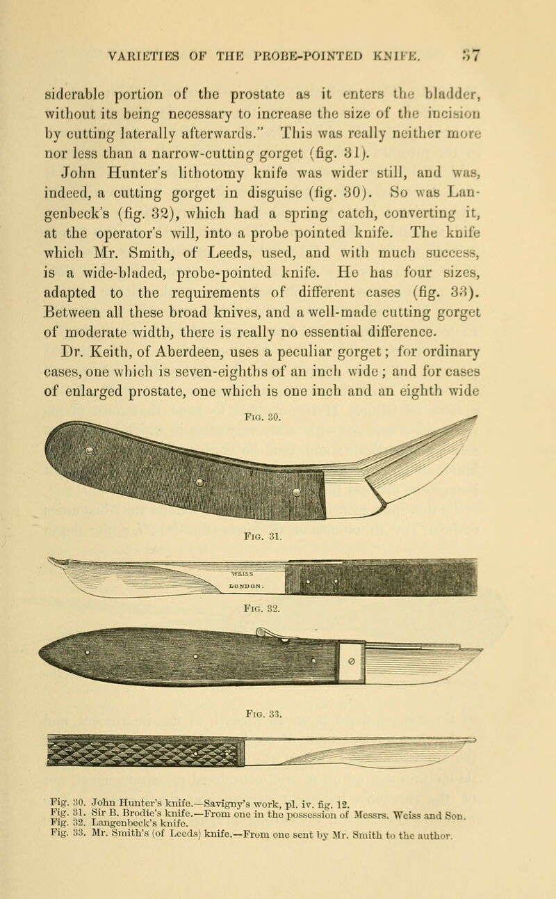 siderable portion of tlio prostate as it enters the bladder, without its being necessary to increase the size of the incision by cutting laterally afterwards. This was n-ally neither more nor less than a narrow-cutting gorget (fig. 81). John Hunter's lithotomy knife was wider still, and was, indeed, a cutting gorget in disguise (fig. 30). So was Lan- genbeck's (fig. 3,2), which had a spring catch, converting it, at the operator's will, into a probe pointed knife. The knife which Mr. Smith, of Leeds, used, and with much sue is a wide-bladed, probe-pointed knife. He has four sizes, adapted to the requirements of different cases (fig. 38). Between all these broad knives, and a well-made cutting gorget of moderate width, there is really no essential difference. Dr. Keith, of Aberdeen, uses a peculiar gorget; for ordinary cases, one which is seven-eighths of an inch wide; and for cases of enlarged prostate, one which is one inch and an eighth wide Fig. 31. Fig. S3. Fig. I!0. John Hunter's knife—Savigny's work, pi. iv. fig. 12. Fig. 81. Sir B. Brodie's knife.—From one in the possession of Messrs. Weiss and Son Fig. '■'•?. Langenbeck's knife. Fig. 33. Mr. Smith's (of Leeds) knife.—From one sent by Mr. Smith to the author.