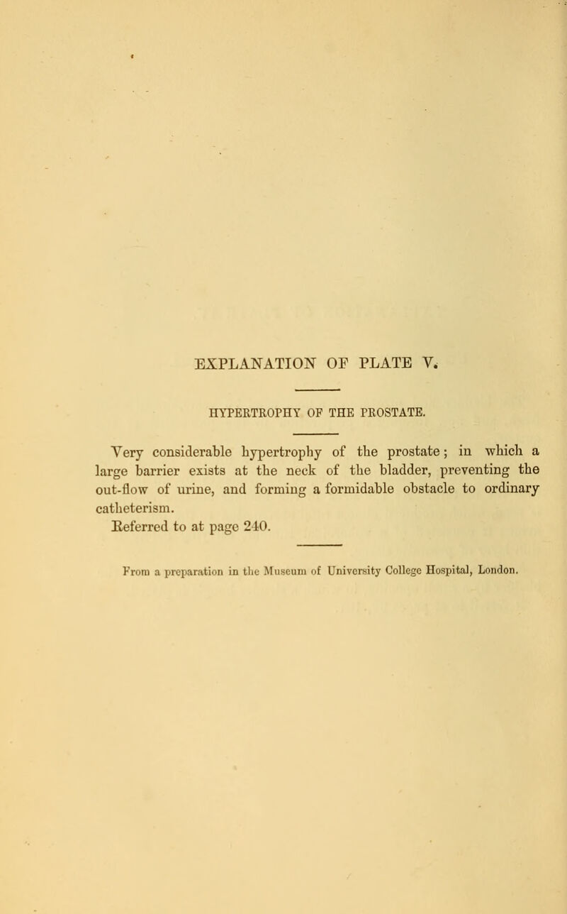 HYPERTROPHY OF THE PROSTATE. Very considerable hypertrophy of the prostate; in which a large barrier exists at the neck of the bladder, preventing the out-flow of urine, and forming a formidable obstacle to ordinary catheterism. Referred to at page 240.