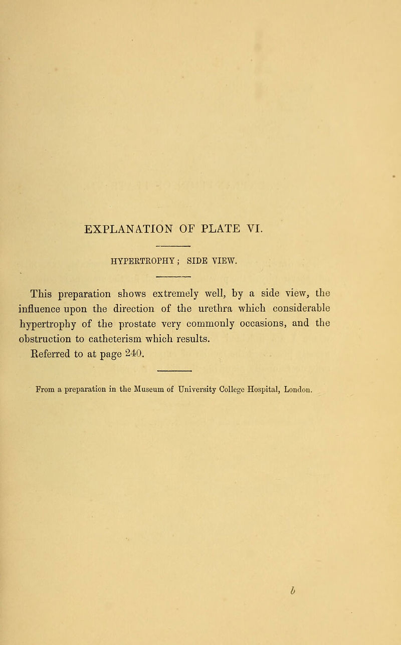 HYPERTROPHY; SIDE VIEW. This preparation shows extremely well, by a side view, the influence upon the direction of the urethra which considerable hypertrophy of the prostate very commonly occasions, and the obstruction to catheterism which results. Referred to at page 240.