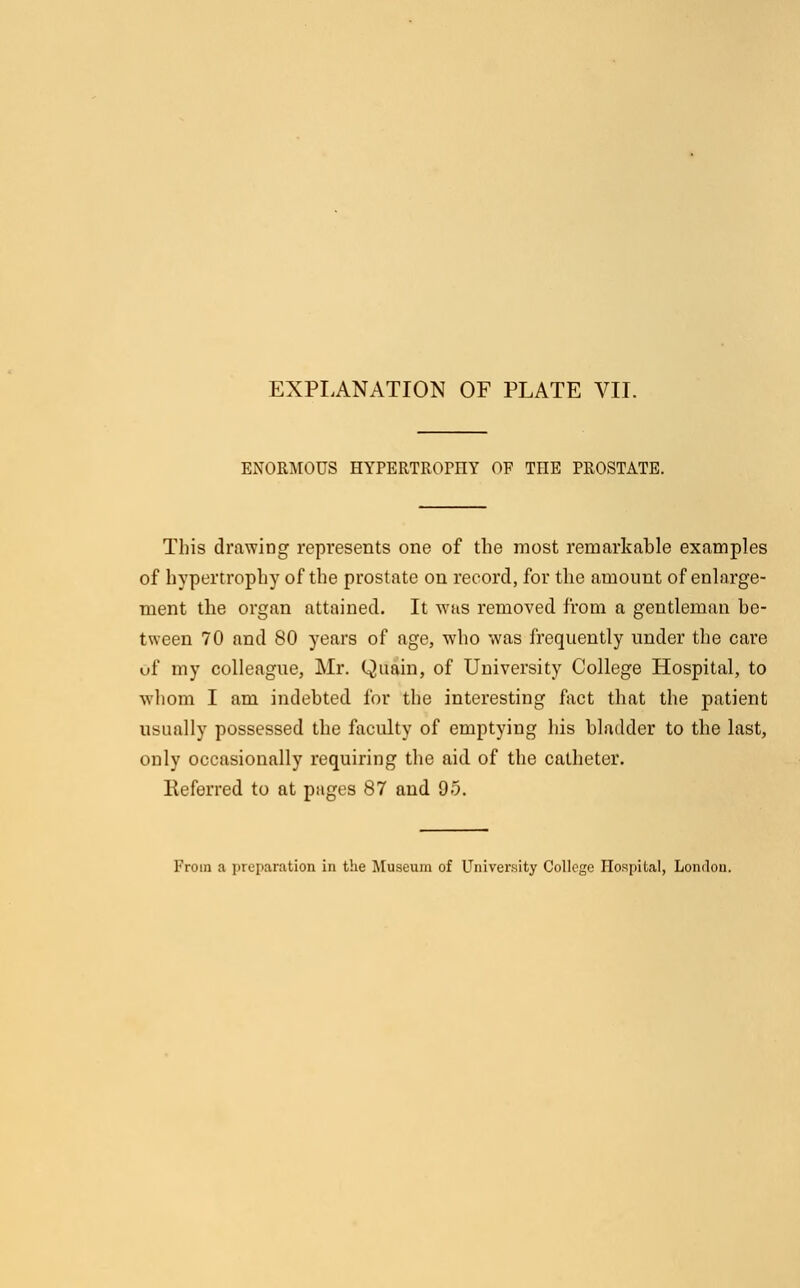 ENORMOUS HYPERTROrnY OF THE PROSTATE. This drawing represents one of the most remarkable examples of hypertrophy of the prostate on record, for the amount of enlarge- ment the organ attained. It was removed from a gentleman be- tween 70 and 80 years of age, who was frequently under the care of my colleague, Mr. Quain, of University College Hospital, to whom I am indebted for the interesting fact that the patient usually possessed the faculty of emptying his bladder to the last, only occasionally requiring the aid of the catheter. Referred to at pages 87 and 95.