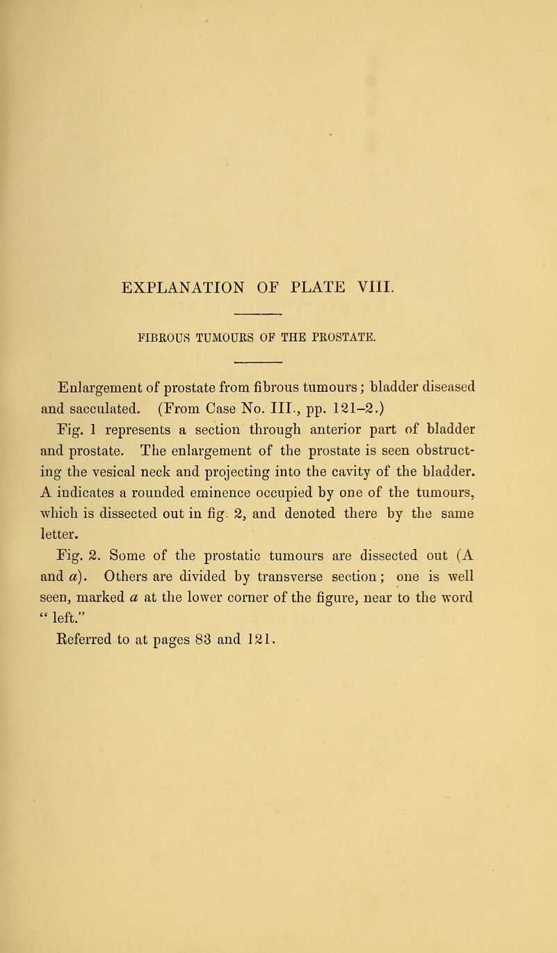 FIBROUS TUMOURS OF THE PROSTATE. Enlargement of prostate from fibrous tumours; bladder diseased and sacculated. (From Case No. III., pp. 121-2.) Fig. 1 represents a section through anterior part of bladder and prostate. The enlargement of the prostate is seen obstruct- ing the vesical neck and projecting into the cavity of the bladder. A indicates a rounded eminence occupied by one of the tumours, which is dissected out in fig. 2, and denoted there by the same letter. Fig. 2. Some of the prostatic tumours are dissected out (A and a). Others are divided by transverse section; one is well seen, marked a at the lower corner of the figure, near to the word  left.