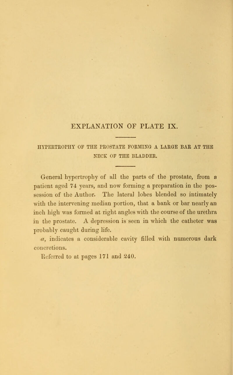 HYPERTROPHY OF THE PROSTATE FORMING A LARGE BAR AT THE NECK OF THE BLADDER. General hypertrophy of all the parts of the prostate, from a patient aged 74 years, and now forming a preparation in the pos- session of the Author. The lateral lobes blended so intimately with the intervening median portion, that a hank or bar nearly an inch high was formed at right angles with the course of the urethra in the prostate. A depression is seen in which the catheter was probably caught during life. a, indicates a considerable cavity filled with numerous dark concretions.