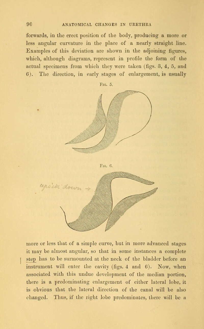 forwards, iu the erect position of the body, producing a more or less angular curvature in the place of a nearly straight line. Examples of this deviation are shown in the adjoining figures, which, although diagrams, represent in profile the form of the actual specimens from which they were taken (figs. 3, 4, 5, and 6). The direction, in early stages of enlargement, is usually Fig. 5. Fig. 6. more or less that of a simple curve, but in more advanced stages it may be almost angular, so that in some instances a complete step has to be surmounted at the neck of the bladder before an instrument will enter the cavity (figs. 4 and 6). Now, when associated with this undue development of the median portion, there is a predominating enlargement of either lateral lobe, it is obvious that the lateral direction of the canal will be also changed. Thus, if the right lobe predominates, there will be a