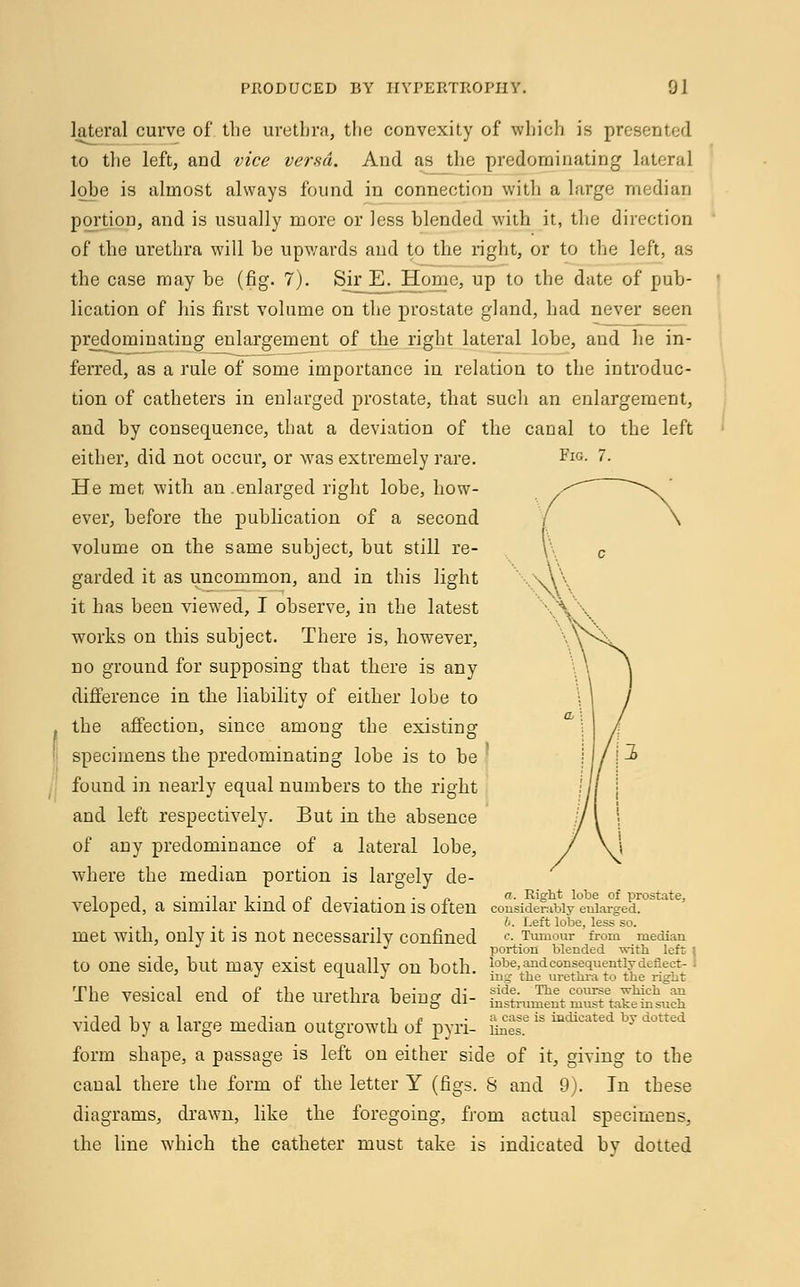 lateral curve of the urethra, the convexity of which is presented to the left, and vice versa. And as the predominating lateral lobe is almost always found in connection with a large median portion, and is usually more or less blended with it, the direction of the urethra will be upwards and to the right, or to the left, as the case may be (fig. 7). Sir E. Home, up to the date of pub- lication of his first volume on the prostate gland, had never seen predominating enlargement of the right lateral lobe, and he in- ferred, as a rule of some importance in relation to the introduc- tion of catheters in enlarged prostate, that such an enlargement, and by consequence, that a deviation of the canal to the left either, did not occur, or was extremely rare. FlG- ?• He met with an .enlarged right lobe, how- ever, before the publication of a second volume on the same subject, but still re- garded it as uncommon, and in this light it has been viewed, I observe, in the latest works on this subject. There is, however, no ground for supposing that there is any difference in the liability of either lobe to the affection, since among the existing specimens the predominating lobe is to be ' found in nearly equal numbers to the right and left respectively. But in the absence of any predominance of a lateral lobe, where the median portion is largely de- -i i -i t • j p -, . ,. „ a. Right lobe of prostate, VelOped, a Similar Kind 01 deviation IS Often considerably enlarged. . , l>. Left lobe, less so. met With, Only it IS not neceSSai'ilv Confined c- Tumour from median  portion blended -svith left tO One Side, but may exist equally OU both, l°be fid consequently deflect- J ± j mg the urethra to the right The vesical end of the urethra being di- ^^tSJ^ vided by a large median outgrowth of pyri- ££?is ****** by dotted form shape, a passage is left on either side of it, giving to the canal there the form of the letter Y (figs. S and 9). In these diagrams, drawn, like the foregoing, from actual specimens, the line which the catheter must take is indicated by dotted