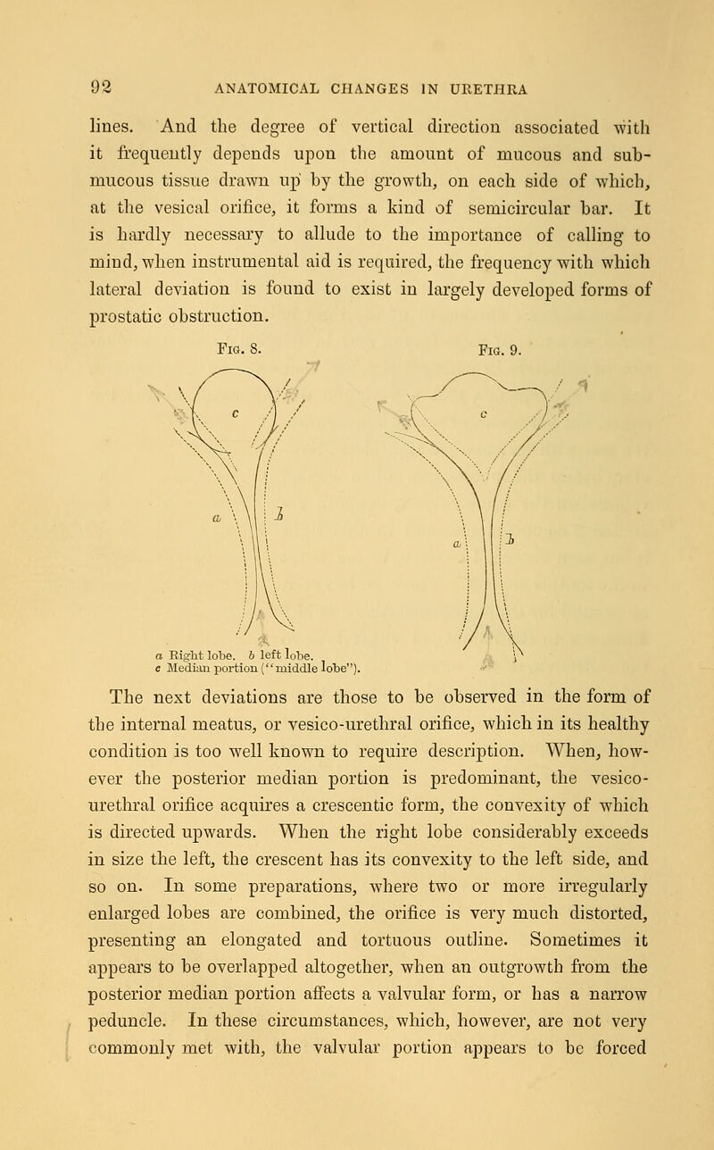 lines. And the degree of vertical direction associated with it frequently depends upon the amount of mucous and sub- mucous tissue drawn up by the growth, on each side of which, at the vesical orifice, it forms a kind of semicircular bar. It is hardly necessary to allude to the importance of calling to mind, when instrumental aid is required, the frequency with which lateral deviation is found to exist in largely developed forms of prostatic obstruction. Fig. 8. Fig. 9. a Right lobe, b left lobe. e Median portion ( middle lobe). The next deviations are those to be observed in the form of the internal meatus, or vesico-urethral orifice, which in its healthy condition is too well known to require description. When, how- ever the posterior median portion is predominant, the vesico- urethral orifice acquires a crescentic form, the convexity of which is directed upwards. When the right lobe considerably exceeds in size the left, the crescent has its convexity to the left side, and so on. In some preparations, where two or more irregularly enlarged lobes are combined, the orifice is very much distorted, presenting an elongated and tortuous outline. Sometimes it appears to be overlapped altogether, when an outgrowth from the posterior median portion affects a valvular form, or has a narrow peduncle. In these circumstances, which, however, are not very commonly met with, the valvular portion appears to be forced