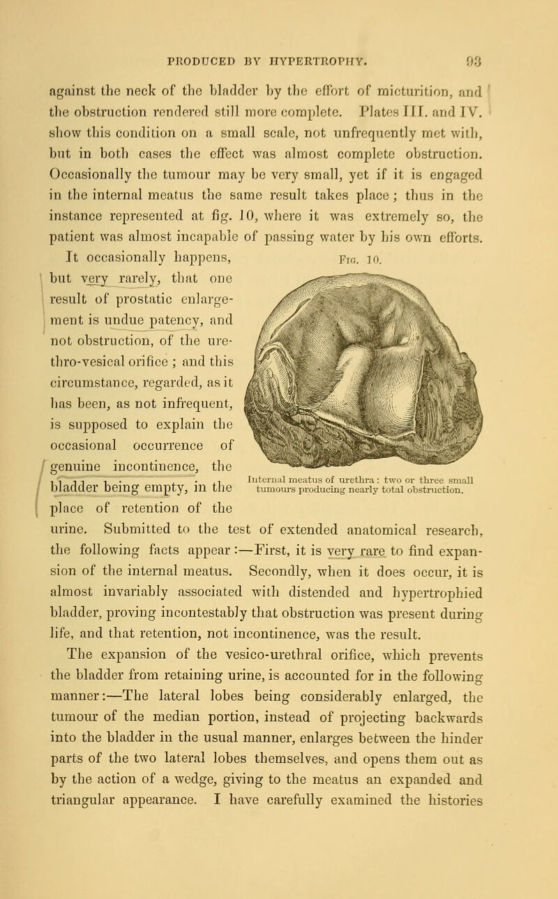 against the neck of the bladder by the effort of micturition, and the obstruction rendered still more complete. Plates III. and IV. show this condition on a small scale, not unfrequently met with, but in both cases the effect was almost complete obstruction. Occasionally the tumour may be very small, yet if it is engaged in the internal meatus the same result takes place; thus in the instance represented at fig. 10, where it was extremely so, the patient was almost incapable of passing water by his own efforts. It occasionally happens, Fir;. 10. but very rarely, that one result of prostatic enlarge- ment is undue patency, and not obstruction, of the ure- thro-vesical orifice ; and this circumstance, regarded, as it has been, as not infrequent, is supposed to explain the occasional occurrence of genuine incontinence, the bladder being empty, in the place of retention of the urine. Submitted to the test of extended anatomical research, the following facts appear :—First, it is very rare to find expan- sion of the internal meatus. Secondly, when it does occur, it is almost invariably associated with distended and hypertrophied bladder, proving incontestably that obstruction was present during life, and that retention, not incontinence, was the result. The expansion of the vesico-urethral orifice, which prevents the bladder from retaining urine, is accounted for in the following- manner:—The lateral lobes being considerably enlarged, the tumour of the median portion, instead of projecting backwards into the bladder in the usual manner, enlarges between the hinder parts of the two lateral lobes themselves, and opens them out as by the action of a wedge, giving to the meatus an expanded and triangular appearance. I have carefully examined the histories Internal meatus of urethra : two or three small tumours producing nearly total obstruction.