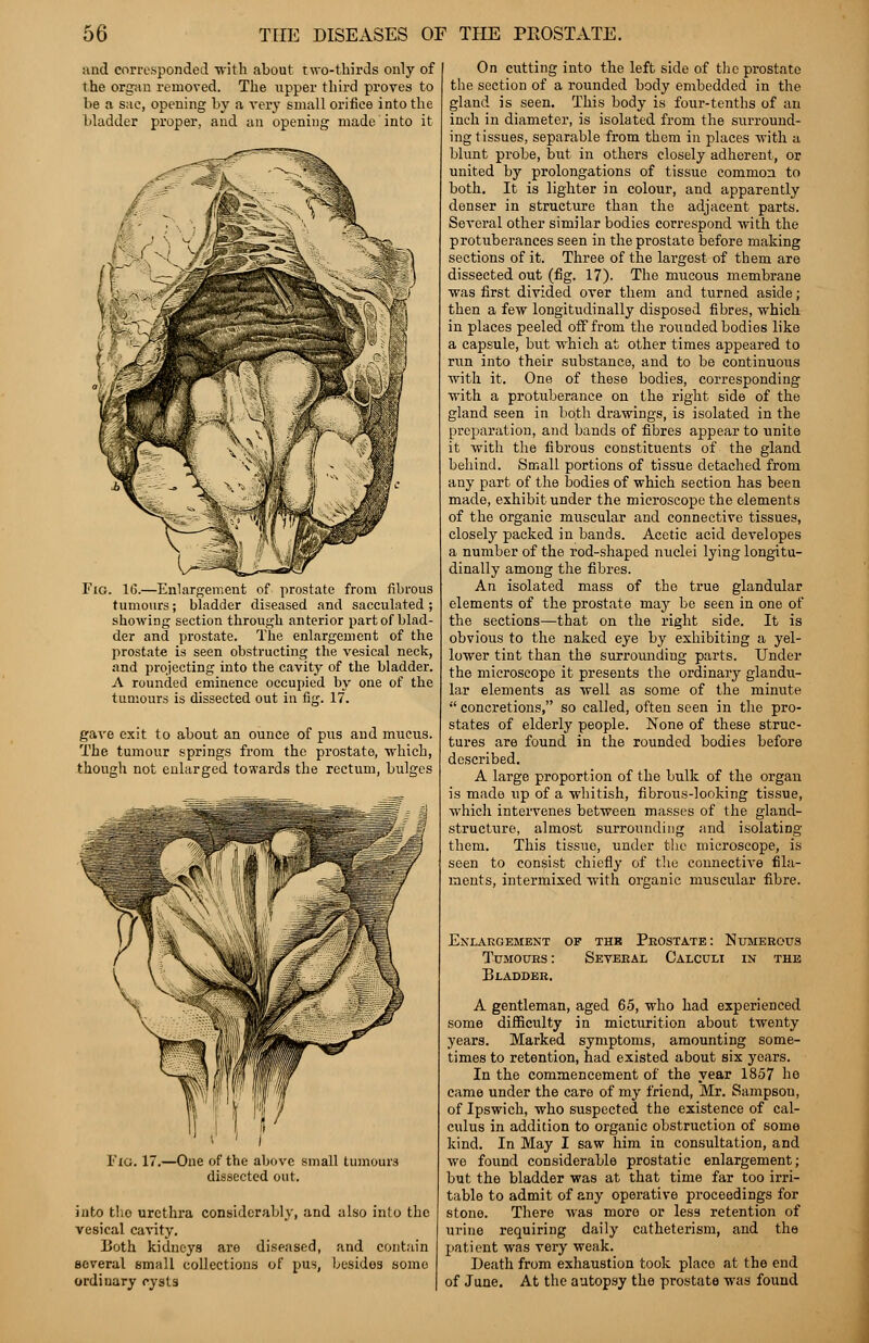 and corresponded with about two-thirds only of the organ removed. The upper third proves to be a sac, opening by a very small orifice into the bladder proper, and an opening made into it Fig. 1(3.—Enlargement of prostate from fibrous tumours; bladder diseased and sacculated ; showing section through anterior part of blad- der and prostate. The enlargement of the prostate is seen obstructing the vesical neck, and projecting into the cavity of the bladder. A rounded eminence occupied by one of the tumours is dissected out in fig. 17. gave exit to about an ounce of pus and mucus. The tumour springs from the prostate, which, though not enlarged towards the rectum, bulges Fig. 17. -One of the above small tumours dissected out. into tho urethra considerably, and also into the vesical cavity. Uoth kidneys are diseased, and contain several small collections of pus, besidos somo ordinary cysts On cutting into the left side of the prostate the section of a rounded body embedded in the gland is seen. This body is four-tenths of an inch in diameter, is isolated from the surround- ing tissues, separable from them in places with a blunt probe, but in others closely adherent, or united by prolongations of tissue common to both. It is lighter in colour, and apparently denser in structure than the adjacent parts. Several other similar bodies correspond with the protuberances seen in the prostate before making sections of it. Three of the largest of them are dissected out (fig. 17). The mucous membrane was first divided over them and turned aside; then a few longitudinally disposed fibres, which in places peeled off from the rounded bodies like a capsule, but which at other times appeared to run into their substance, and to be continuous with it. One of these bodies, corresponding with a protuberance on the right side of the gland seen in both drawings, is isolated in the preparation, and bands of fibres appear to unite it with the fibrous constituents of the gland behind. Small portions of tissue detached from any part of the bodies of which section has been made, exhibit under the microscope the elements of the organic muscular and connective tissues, closely packed in bands. Acetic acid developes a number of the rod-shaped nuclei lying longitu- dinally among the fibres. An isolated mass of the true glandular elements of the prostate may be seen in one of the sections—that on the right side. It is obvious to the naked eye by exhibiting a yel- lower tint than the surrounding parts. Under the microscope it presents the ordinary glandu- lar elements as well as some of the minute  concretions, so called, often seen in the pro- states of elderly people. None of these struc- tures are found in the rounded bodies before described. A large proportion of the bulk of the organ is made up of a whitish, fibrous-looking tissue, which intervenes between masses of the gland- structure, almost surrounding and isolating them. This tissue, under the microscope, is seen to consist chiefly of the connective fila- ments, intermixed with organic muscular fibre. Enlargement of the Prostate: Numerous Tumours : Several Calculi in the Bladder. A gentleman, aged 65, who had experienced some difficulty in micturition about twenty years. Marked symptoms, amounting some- times to retention, had existed about six years. In the commencement of the year 1857 he came under the care of my friend, Mr. Sampson, of Ipswich, who suspected the existence of cal- culus in addition to organic obstruction of some kind. In May I saw him in consultation, and we found considerable prostatic enlargement; but the bladder was at that time far too irri- table to admit of any operative proceedings for stone. There was more or less retention of urine requiring daily catheterism, and the patient was very weak. Death from exhaustion took placo at the end of June. At the autopsy the prostate was found