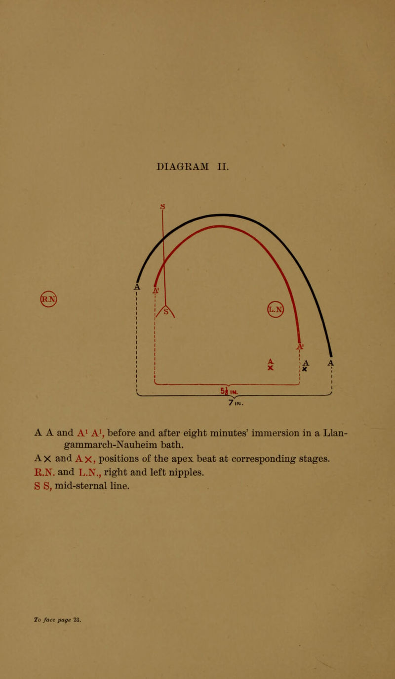 DIAGRAM II. 7.N. A A and A1 A1, before and after eight minutes' immersion in a Llan- gammarch-Nauheim bath. A x and A x, positions of the apex beat at corresponding stages. R.N. and L.N., right and left nipples. S S, mid-sternal line.