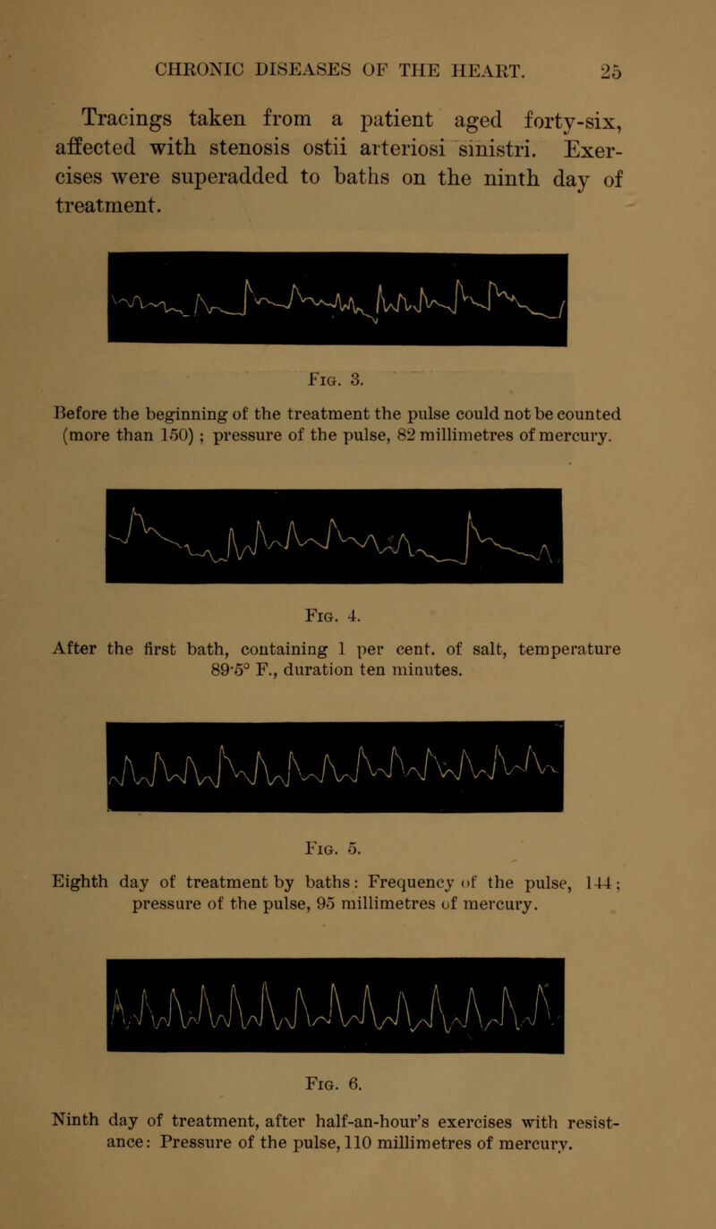 Tracings taken from a patient aged forty-six, affected with stenosis ostii arteriosi smistri. Exer- cises were superadded to baths on the ninth day of treatment. Fro. 3. Before the beginning of the treatment the pulse could not be counted (more than 150) ; pressure of the pulse, 82 millimetres of mercury. Fig. 4. After the first bath, containing 1 per cent, of salt, temperature 895° F., duration ten minutes. Fig. o. Eighth day of treatment by baths: Frequency of the pulse, 144 pressure of the pulse, 95 millimetres of mercury. Fig. 6. Ninth day of treatment, after half-an-hour's exercises with resist- ance: Pressure of the pulse, 110 millimetres of mercury.