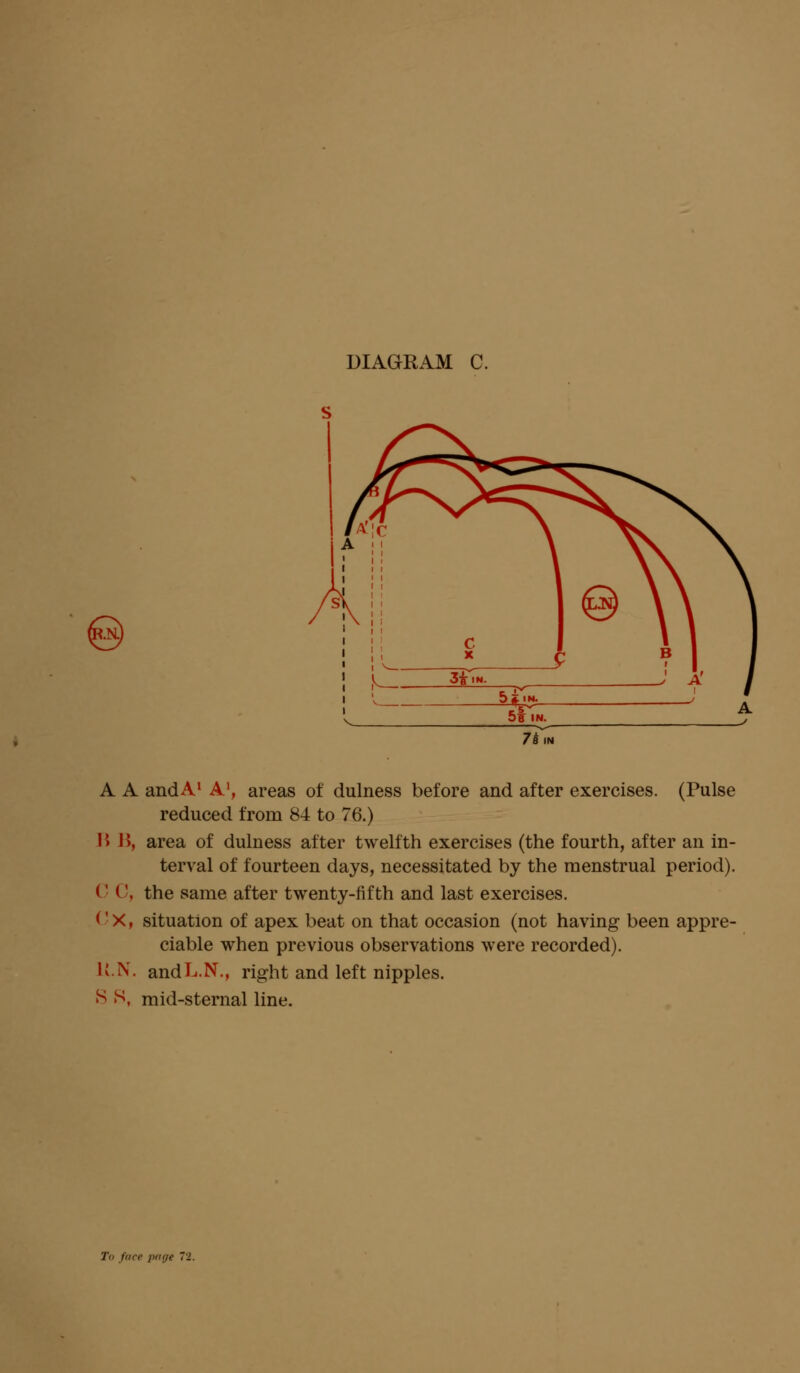 A A andA1 A1, areas of dulness before and after exercises. (Pulse reduced from 84 to 76.) I> B, area of dulness after twelfth exercises (the fourth, after an in- terval of fourteen days, necessitated by the menstrual period). 0 C, the same after twenty-fifth and last exercises. (' X, situation of apex beat on that occasion (not having been appre- ciable when previous observations were recorded). U.N. andL.N., right and left nipples. S S, mid-sternal line.