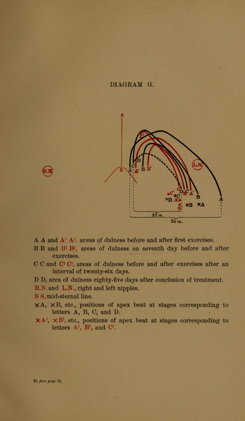 5? IN. A A and A1 A1, areas of dulness before and after first exercises. B B and B1 B1, areas of dulness on seventh day before and after exercises. C C and C1 C5, areas of dulness before and after exercises after an interval of twenty-six days. D D, area of dulness eighty-five days after conclusion of treatment. R.N.and L.N., right and left nipples. S S, mid-sternal line. XA, xB, etc., positions of apex beat at stages corresponding to letters A, B, C, and D. XA1, XB1, etc., positions of apex beat at stages corresponding to letters A1, B1, and C1.
