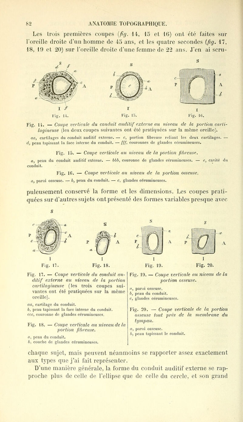 Les trois premières coupes (fig. 14, 15 et 16) ont été faites sur l'oreille droite d'un homme de 45 ans, et les quatre secondes (fig. 17, 18, 19 et 20) sur l'oreille droite d'une femme de 22 ans. J'en ai scru- Fig. 16. Fig. 14. — Coupe verticale du conduit auditif externe au niveau de la portion carti- lagineuse (les deux coupes suivantes ont été pratiquées sur la même oreille). aa, cartilages du conduit auditif externe. — c, portion fibreuse reliant les deux cartilages. — d, peau tapissant la face interne du conduit. — fff, couronnes de glandes cérumineuses. Fig. 15. — Coupe verticale au niveau de la portion fibreuse. a, peau du conduit auditif externe, conduit. bbb, couronne de glandes cérumineuses. — e, cavité du Fig. 16. — Coupe verticale au niveau de la portion osseuse, a, paroi osseuse. — 6, peau du conduit. — c, glandes cérumineuses. puleusement conservé la forme et les dimensions. Les coupes prati- quées sur d'autres sujets ont présenté des formes variables presque avec Fie. 17. Fig. 18. Fig. 17. — Coupe verticale du conduit au- ditif externe au niveau de la portion cartilagineuse (les trois coupes sui- vantes ont été pratiquées sur la même oreille). aa, cartilage du conduit. b, peau tapissant la face interne du conduit. cce, couronne de glandes cérumineuses. Fig. 18. — Coupe verticale au niveau de la portion fibreuse. a, peau du conduit. b, couche de glandes cérumineuses. A Fig. 20. Fig. 19. — Coupe verticale au niveau de la portion osseuse. a, paroi osseuse. b, peau du conduit. c, glandes cérumineuses. Fig. 20. — Coupe verticale de la portion osseuse tout près de la membrane du tympan. a, paroi osseuse. b, peau tapissant le conduit. chaque sujet, mais peuvent néanmoins se rapporter assez exactement aux types que j'ai fait représenter. D'une manière générale, la forme du conduit auditif externe se rap- proche plus de celle de l'ellipse que de celle du cercle, et son grand