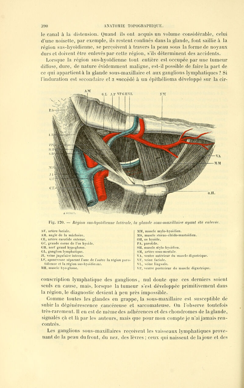 le canal à la distension. Quand ils ont acquis un volume considérable, celui d'une noisette, par exemple, ils restent confinés dans la glande, font saillie à la région sus-hyoïdienne, se perçoivent à travers la peau sous la forme de noyaux durs et doivent être enlevés par cette région, s'ils déterminent des accidents. Lorsque la région sus-hyoïdienne tout entière est occupée par une tumeur diffuse, dure, de nature évidemment maligne, est-il possible de faire la part de ce qui appartientà la glande sous-maxillaire et aux ganglions lymphatiques? Si l'induration est secondaire et a succédé à un épithélioma développé sur la cir- G.L A.F VF envi or Fig. 120. — Région sus-hyoïdie?i?ie latérale, la glande sôus-maxillaire ayant été enlevée. A F, artère faciale. AM, angle de la mâchoire. CE, artère carotide externe. GC, grande corne de l'os hyoïde. GH, nerf grand hypoglosse. GL, ganglion lymphatique. .II, veine jugulaire interne. LF, aponévrose séparant l'une de l'autre la région paro- tidieime et la région sus-hyoïdienne. MH, muscle hyo-glosse. MM, muscle mylo-hyoïdien. MS, muscle sterno-cléido-mastoïdieu. OH, os hyoïde. PA, parotide. SH, muscle stylo-hyoïdien. S3I, artère sous-mentale. VA, ventre antérieur du muscle digastrique. VF, veine faciale. YL, veine linguale. VI', ventre postérieur du muscle digastrique. conscription lymphatique des ganglions, nul doute que ces derniers soient seuls en cause, mais, lorsque la tumeur s'est développée primitivement dans la région, le diagnostic devient à peu près impossible. Comme toutes les glandes en grappe, la sous-maxillaire est susceptible de subir la dégénérescence cancéreuse et sarcomateuse. On l'observe toutefois très-rarement. Il en est de même des adhérences et des chondromes de la glande, signalés çà et là par les auteurs, mais que pour mon compte je n'ai jamais ren- contrés. Les ganglions sous-maxillaires reçoivent les vaisseaux lymphatiques prove- nant de la peau du front, du nez, des lèvres ; ceux qui naissent de la joue et des