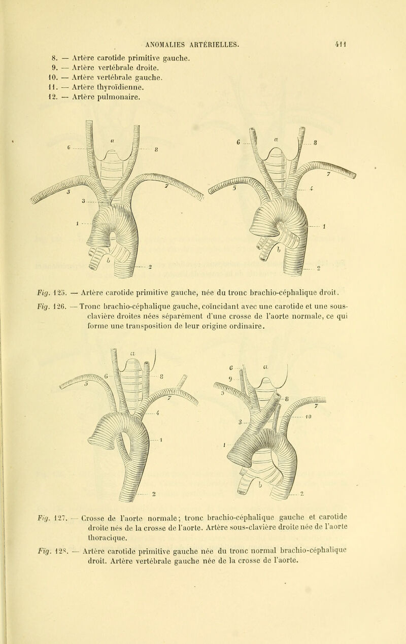 8. — Artère carotide primitive gauche. 9. — Artère vertébrale droite. 10. — Artère vertébrale gauche. 11. — Artère thyroïdienne. 12. — Artère pulmonaire. Fig. 123. — Artère carotide primitive gauche, née du tronc brachio-céphalique droit. Fig. 126. — Tronc brachio-céphalique gauche, coïncidant avec une carotide et une sous- clavière droites nées séparément d'une crosse de l'aorte normale, ce qui forme une transposition de leur origine ordinaire. Fig. 127. — Crosse de l'aorte normale; tronc brachio-céphalique gauche et carotide droite nés de la crosse de l'aorte. Artère sous-clavière droite née de l'aorte thoracique. Fig. 12S. — Artère carotide primitive gauche née du tronc normal brachio-céphalique droit. Artère vertébrale gauche née de la crosse de l'aorte.