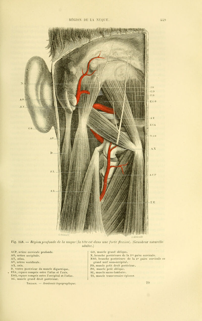 REGluN DE IA NUQUE. 44W cm coter. Fig. 148. — Région profonde de la nuque (la tète est dans une forte flexion). (Grandeur naturelle adulte.) ACP, artère cervicale profonde. AO, artère occipitale. AT, atlas. AV, artère vertébrale. AX, axis. D, ventre postérieur du muscle digastrique. ESA, espace compris entre l'atlas et l'axis. ESO, espace compris entre l'occipital et l'atlas. DG, muscle grand droit postérieur. Tillaux. — Anntomie topographique. GO, muscle grand oblique. N, branche postérieure de la lre paire cervicale. NSO, branche postérieure de la 2e paire cervicale ou grand nerf sous-occipital. PD, muscle petit droit postérieur. PO, muscle petit oblique. SL, muscle sacro-lombaire. TE, muscle transversaire épiueux 29